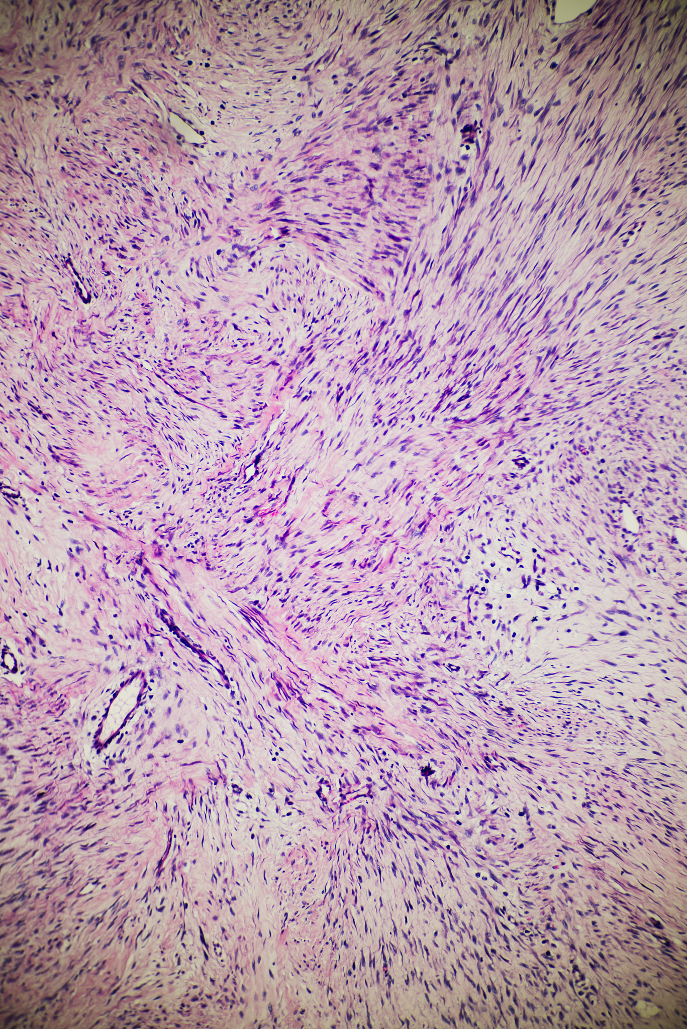 子宫肌瘤如何区分恶性？ - 详细指南