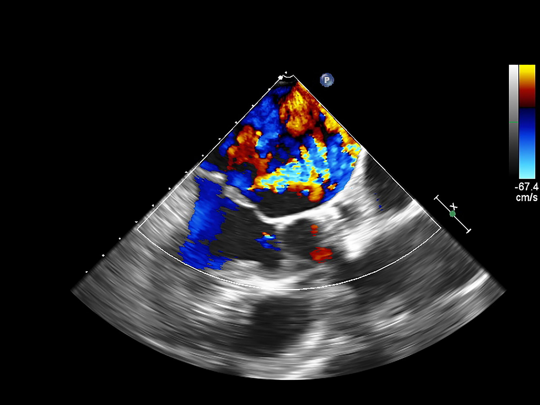 超声造影评估新生血管生成与巨噬细胞浸润的相关性