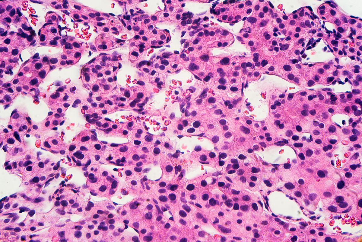 肝癌和肝血管瘤的区别:影像学和病理学鉴别 肝癌和肝血管瘤的区别:影像学和病理学鉴别