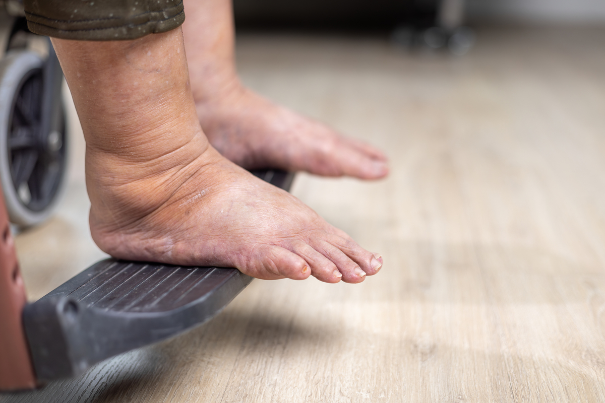 老年人脚肿是什么原因？