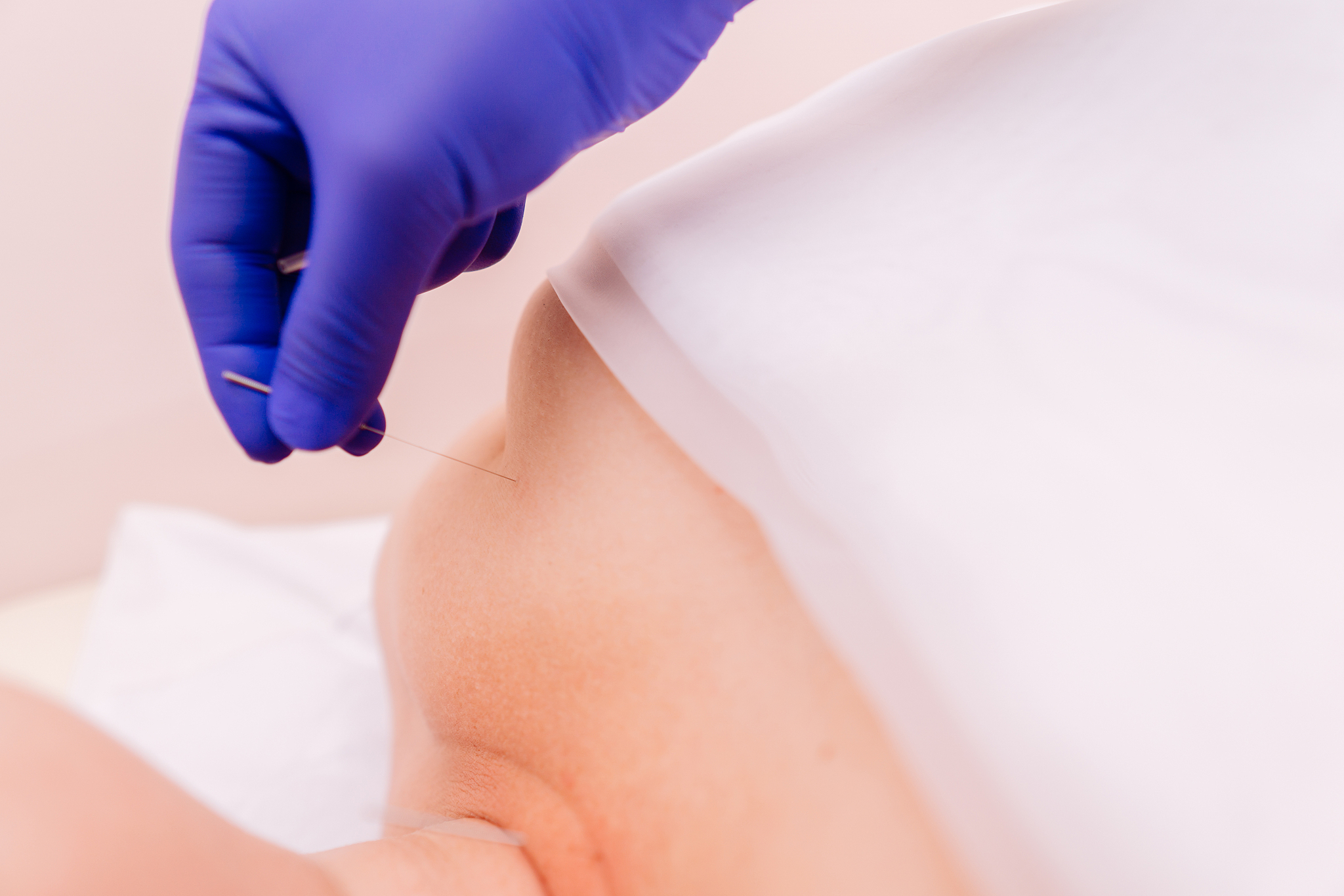 young woman getting acupuncture treatment