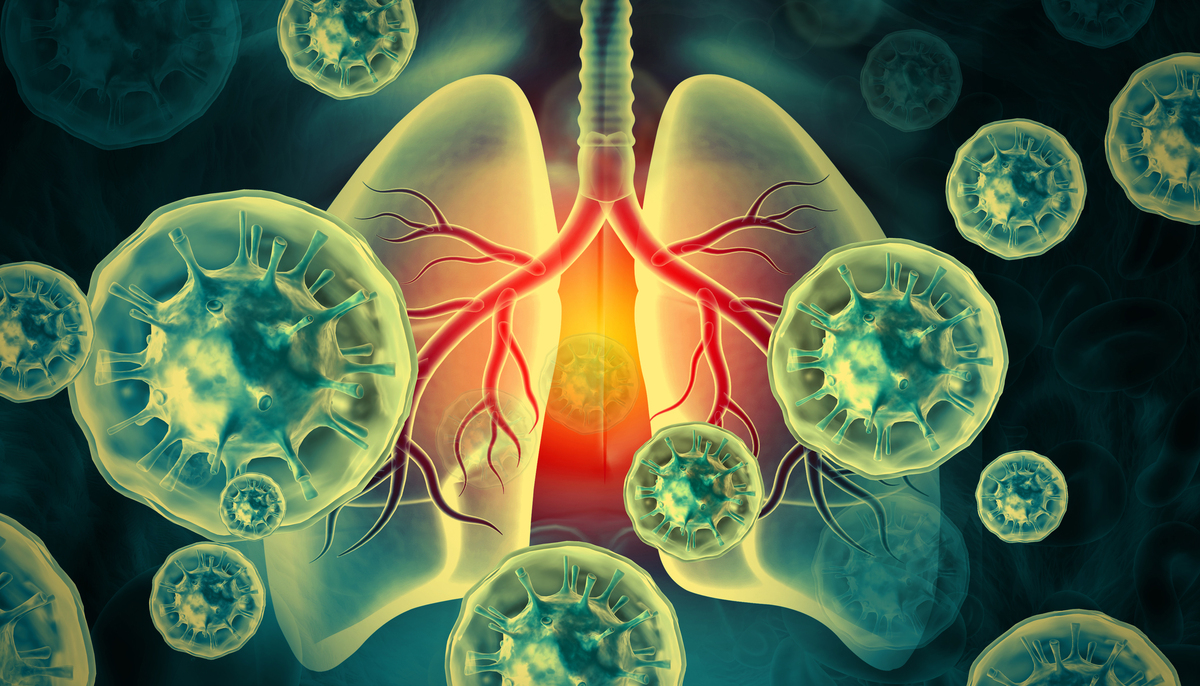 慢阻肺急性加重期：症状、治疗和预防