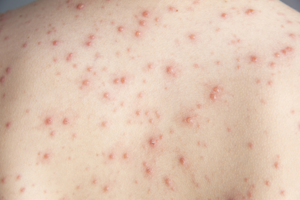 荨麻疹、湿疹和毛囊炎的鉴别：症状、病因和治疗方法 - 皮肤病科普