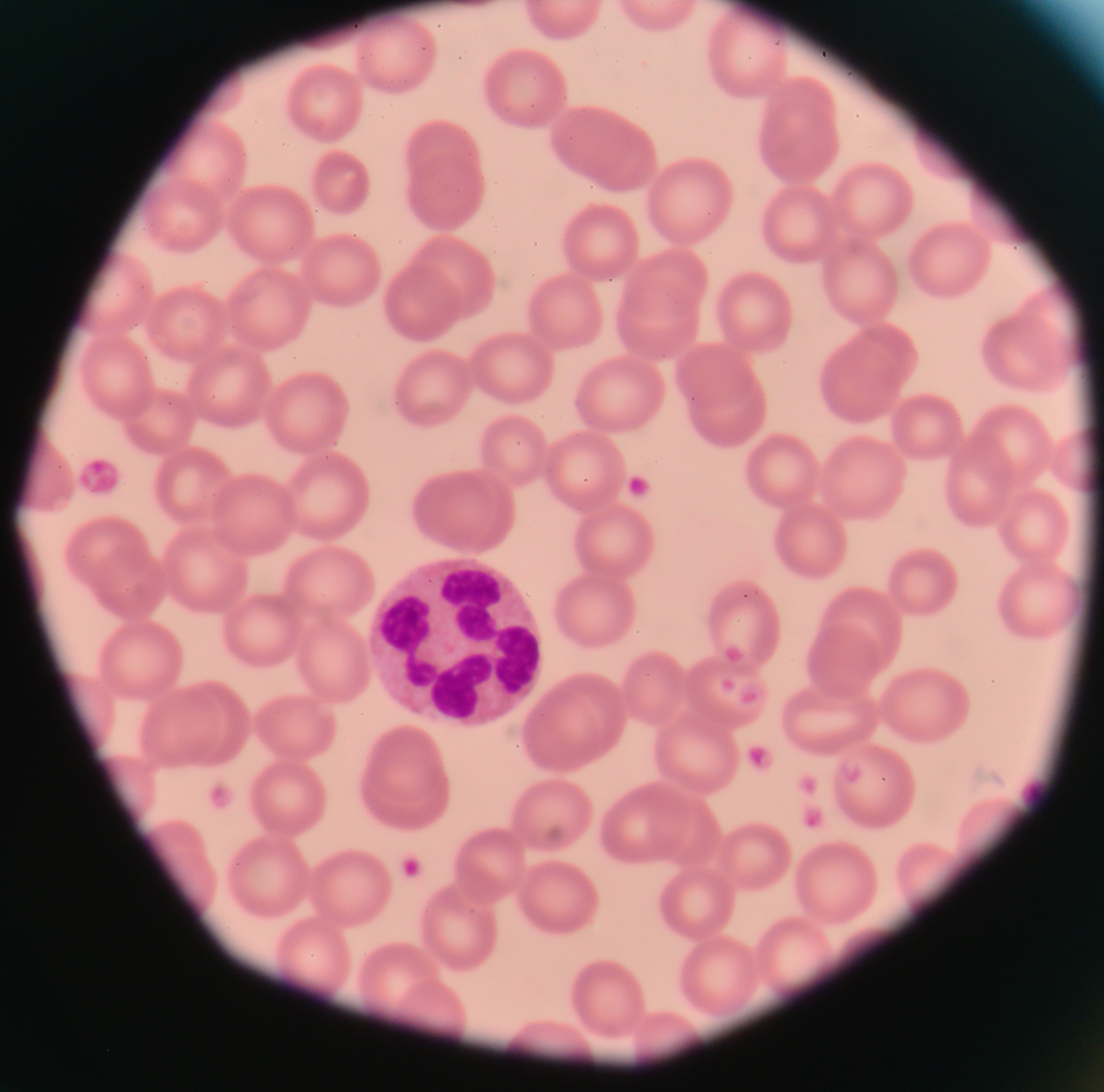 请翻译并概括下面这段英文：The role of platelets in both the initiation and propagation of cardiovascular disease has been firmly established over the past 2 decades1–3 The importance of platelets in cardiovascular