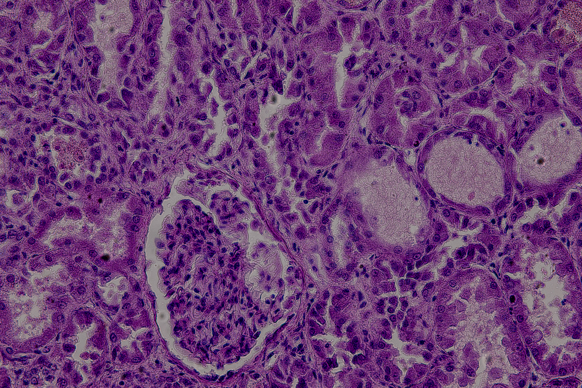 MMP-14高表达与三阴性乳腺癌肺转移的关联：机制与干预策略