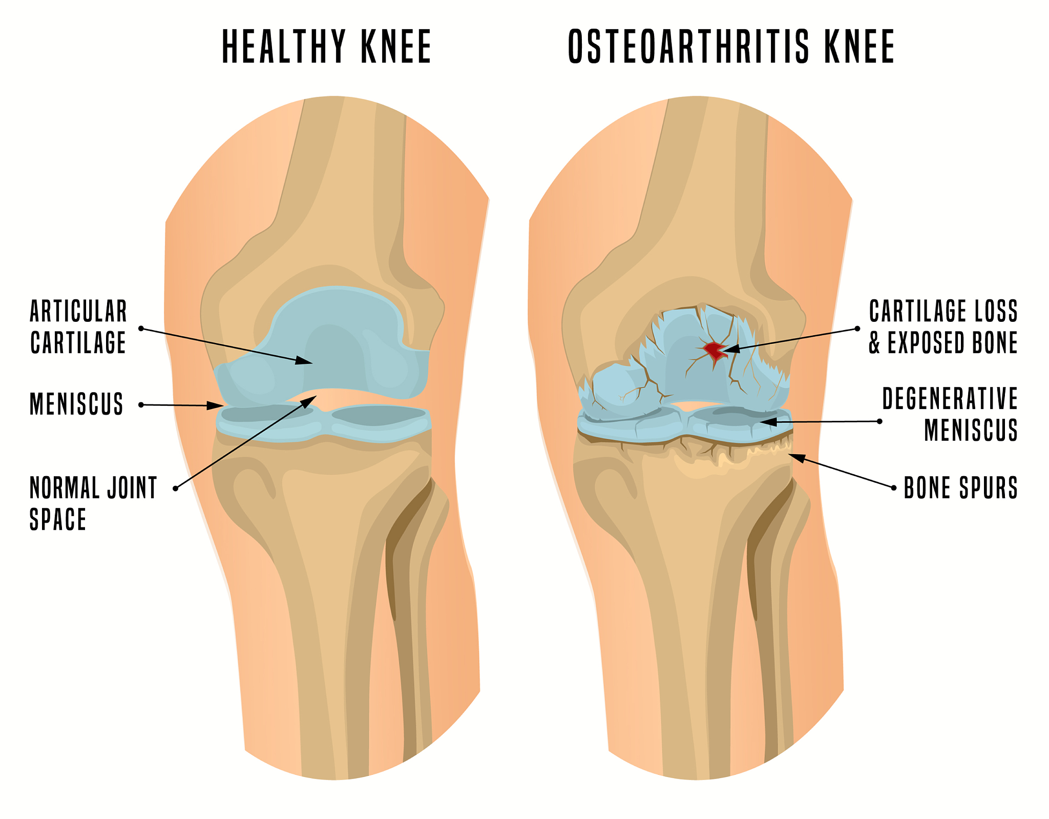 个性化治疗算法模型优化膝关节骨关节炎患者长期疗效：一项荟萃分析