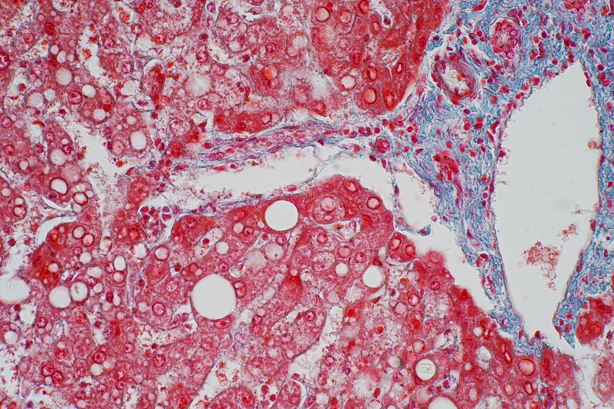 Iga肾病发展出fsgs 是不是比较严重