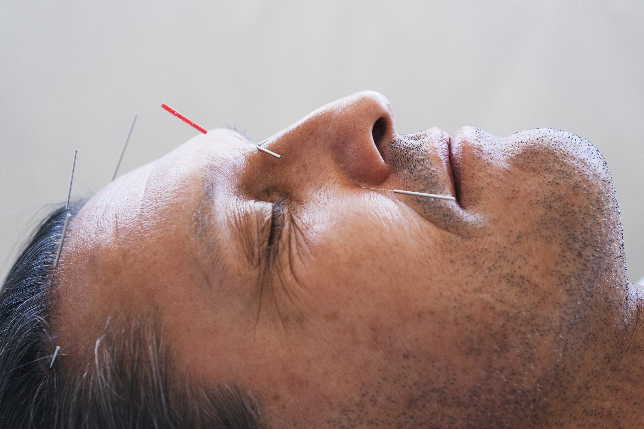 脸上长毛怎么永久去掉男生1 激光脱毛：这是一种比较常见的永久脱毛方法适用于面部、颈部、胸部等部位。通过激光束照射毛囊使其受热分解达到永久去除毛发的效果。2 电疗脱毛：也称为电针脱毛是将毛发的毛囊用高频电流加热使毛发萎缩达到减少毛发数量的效果。3 高频电波脱毛：是利用高频电波对毛囊进行灼烧和氧化达到永久脱毛的效果。这种方法比较温和不会对皮肤造成损伤。4 Ipl脱毛：是通过IPlIntense Pul