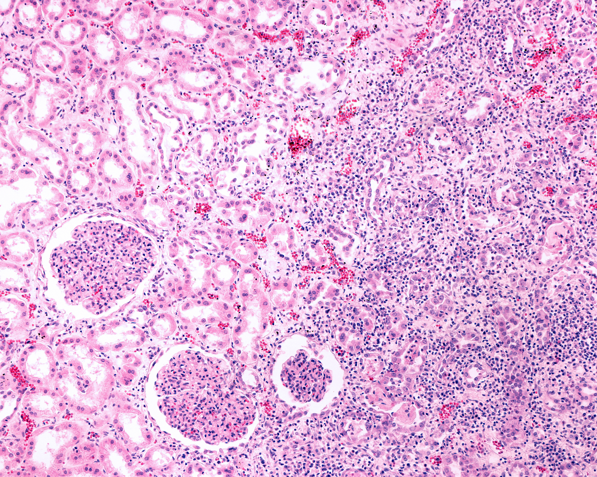 系统性红斑狼疮的临床表现、实验和其他检查、诊断和鉴别诊断