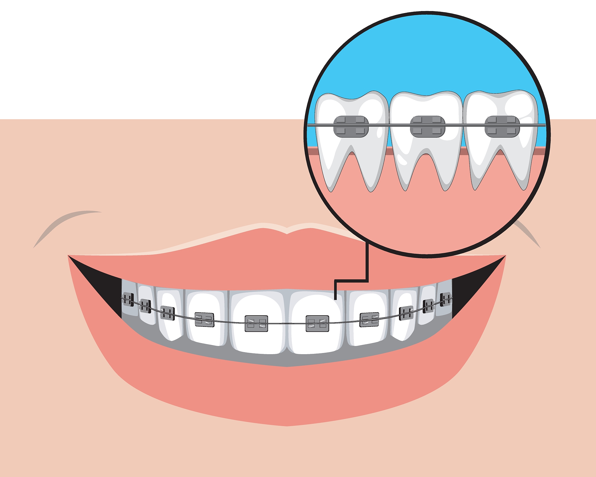 拔掉一颗牙齿后如果不植新的牙两边的牙齿会歪吗