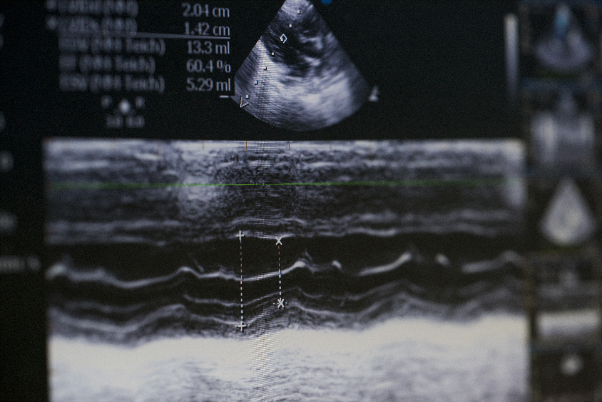 3D超声造影技术可直观显示斑块内溃疡和漂浮血栓