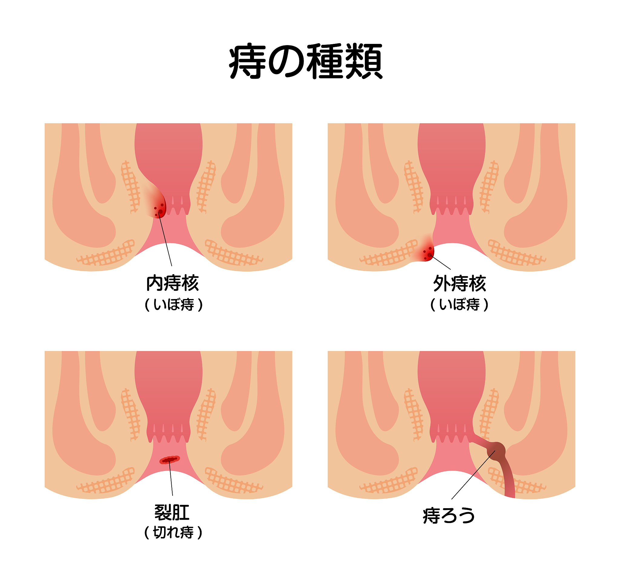 <strong>痔疮</strong>,绘画插图,日本,矢量,公寓,生物学,横截面,健康保健,部分,背景
