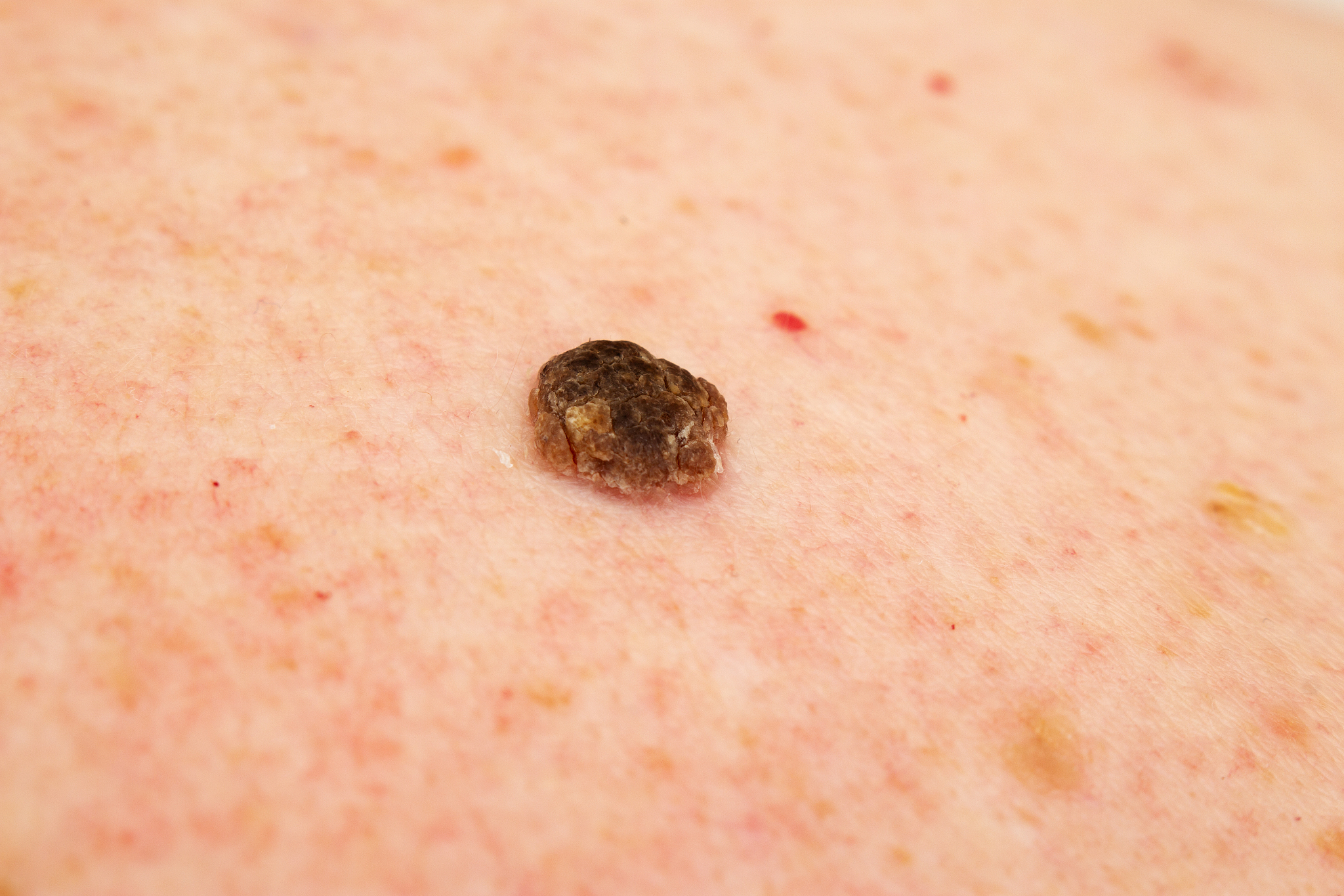 seborrheic keratosis also known as seborrheic verruca or a senil