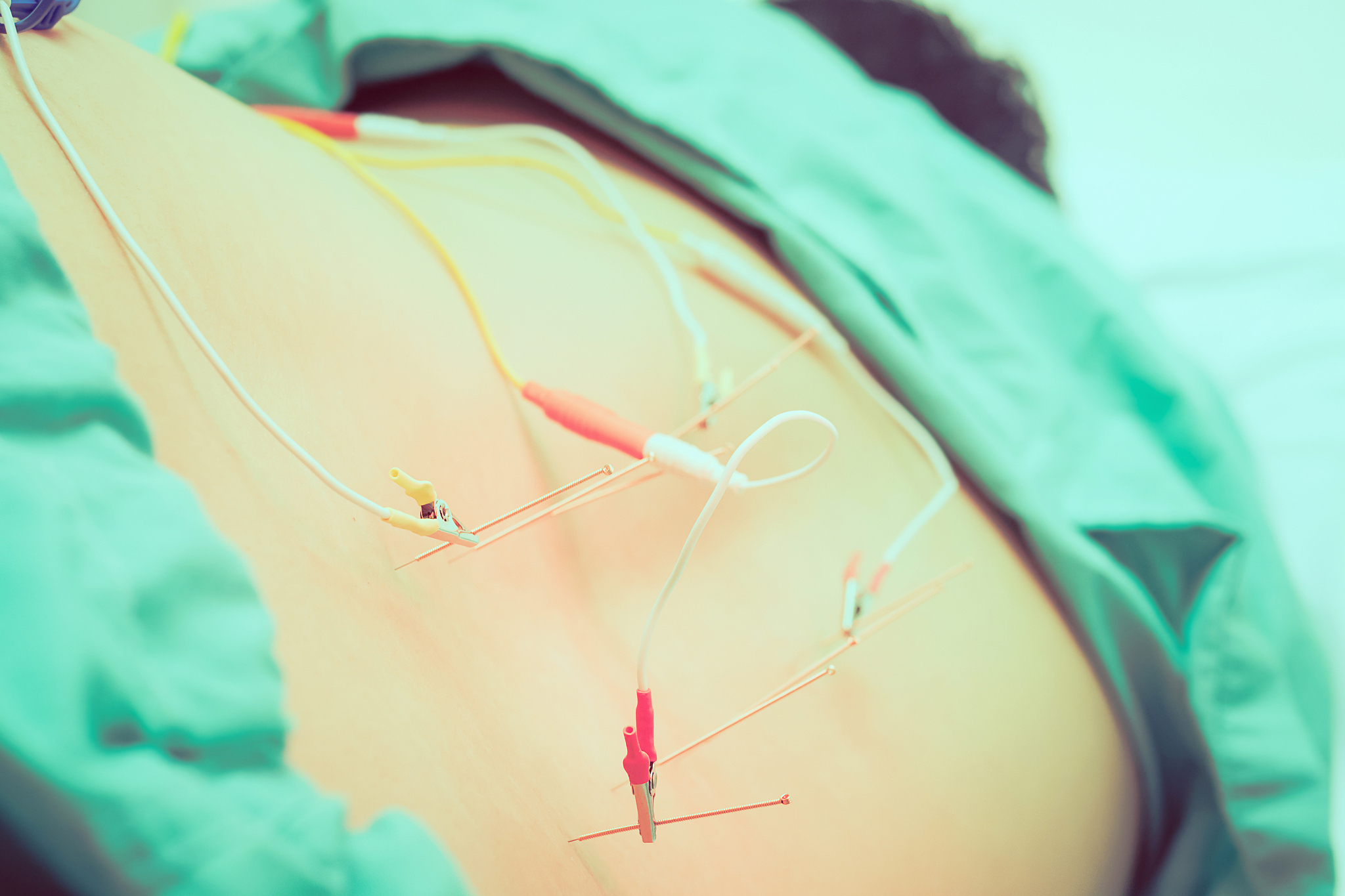 patient receiving acupuncture treatment at medical clinic
