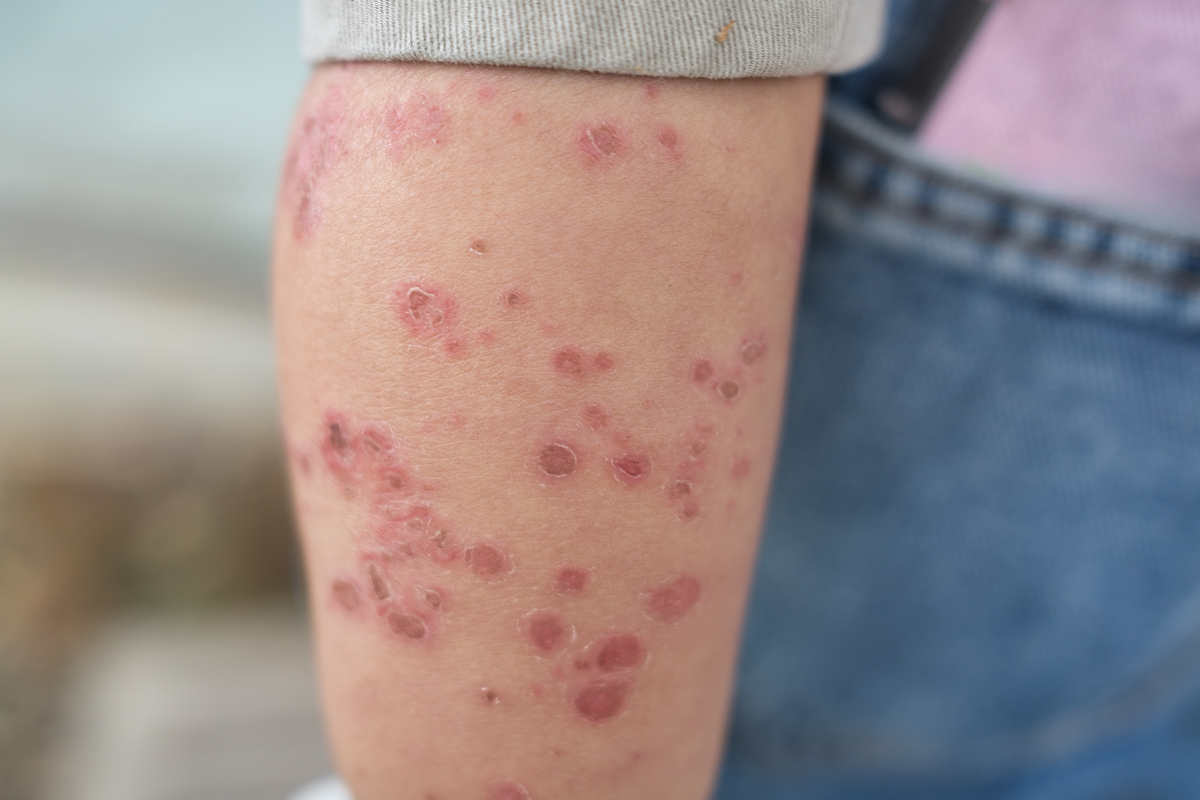 毛囊炎≠艾滋病：了解真相，避免误解