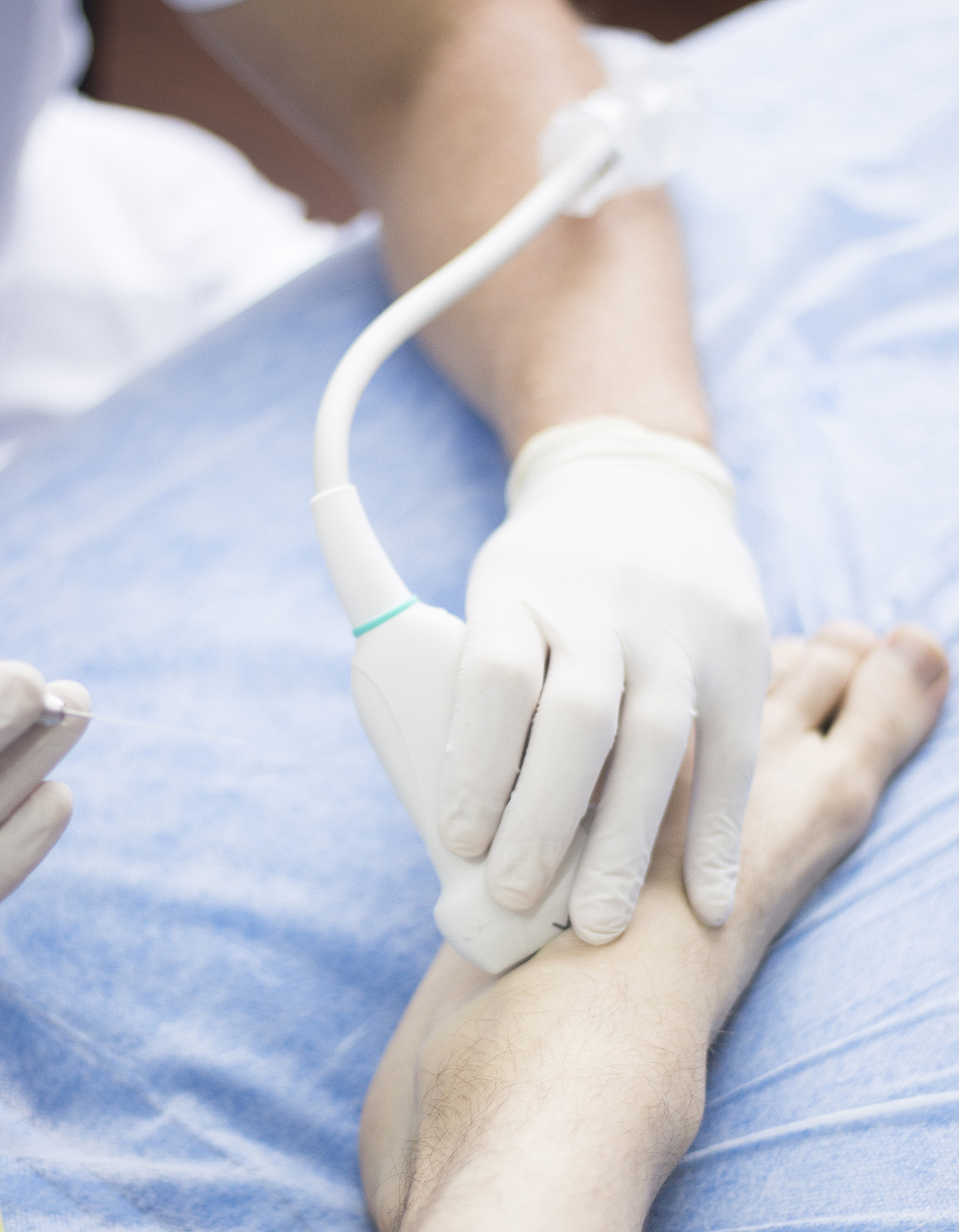 ultrasound assisted epi ecography intratissue percutaneous elect