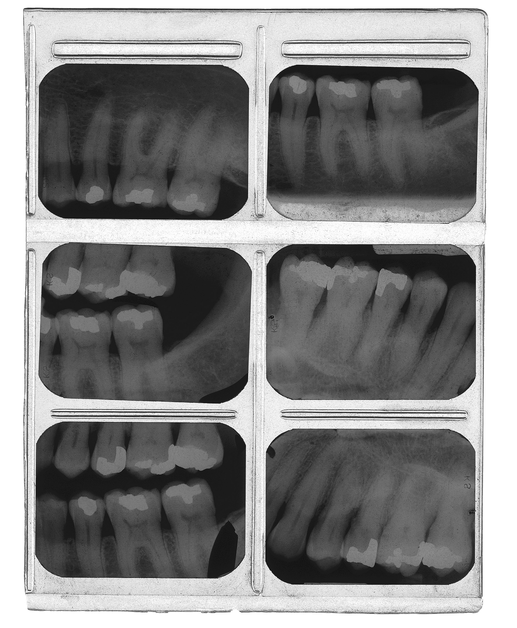 理基于根管治疗中的疼痛管的影响研究目的：探讨……………………………………………………………的影响方法：选择……随机分为观察组n=30和对照组n=30。对观察组……；对照组只是……。……后采用……进行评分。结果：观察组…………高于对照组有显著性差异P 001。结论：……的影响研究。前言 1 对象和方法前瞻性研究的格式1 材料和方法回顾性研究的格式11对象材料 采用……等来源须具体、明确。12方法