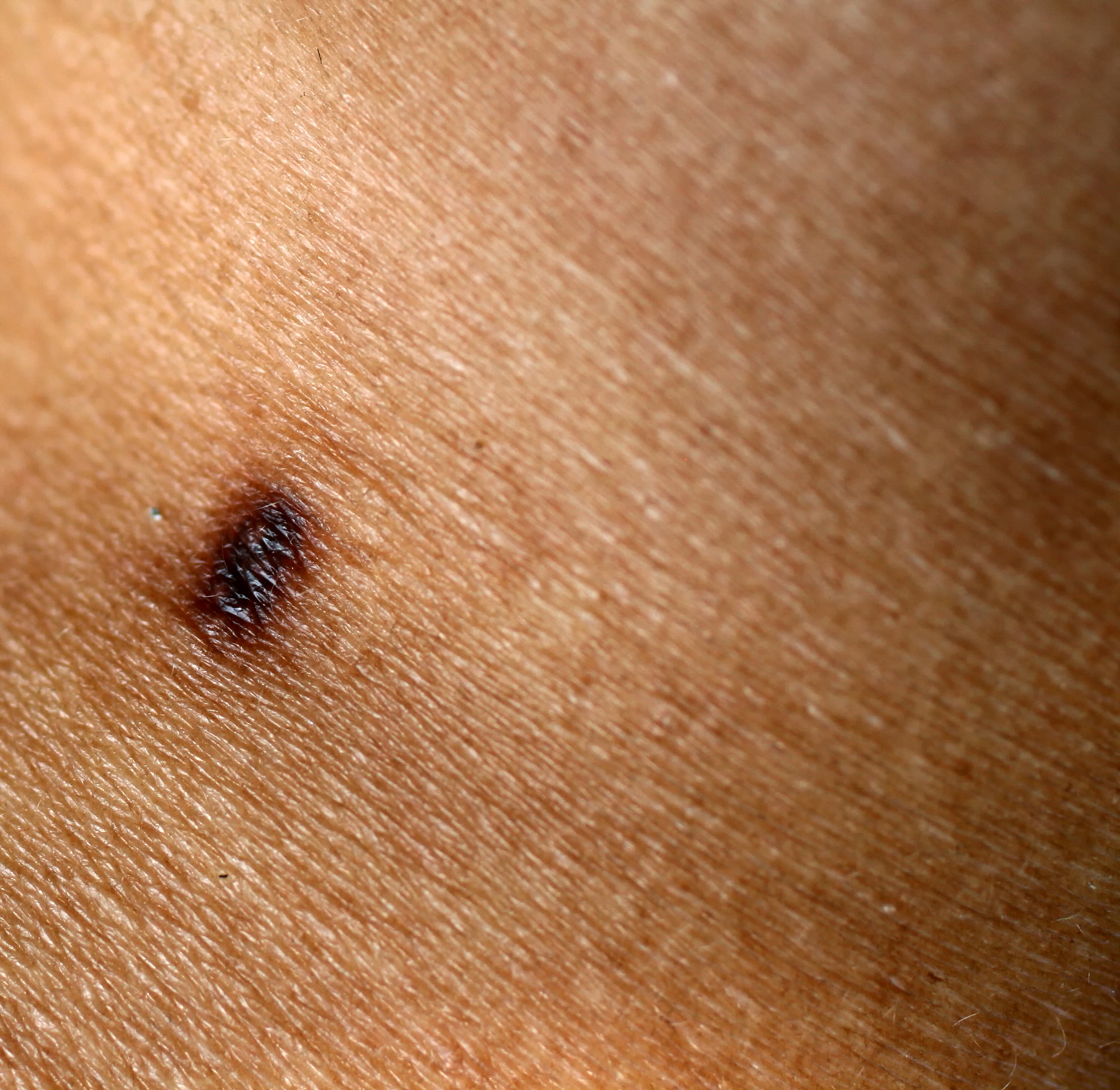 removal of a birthmark with a laser. brown trace from birthmark 