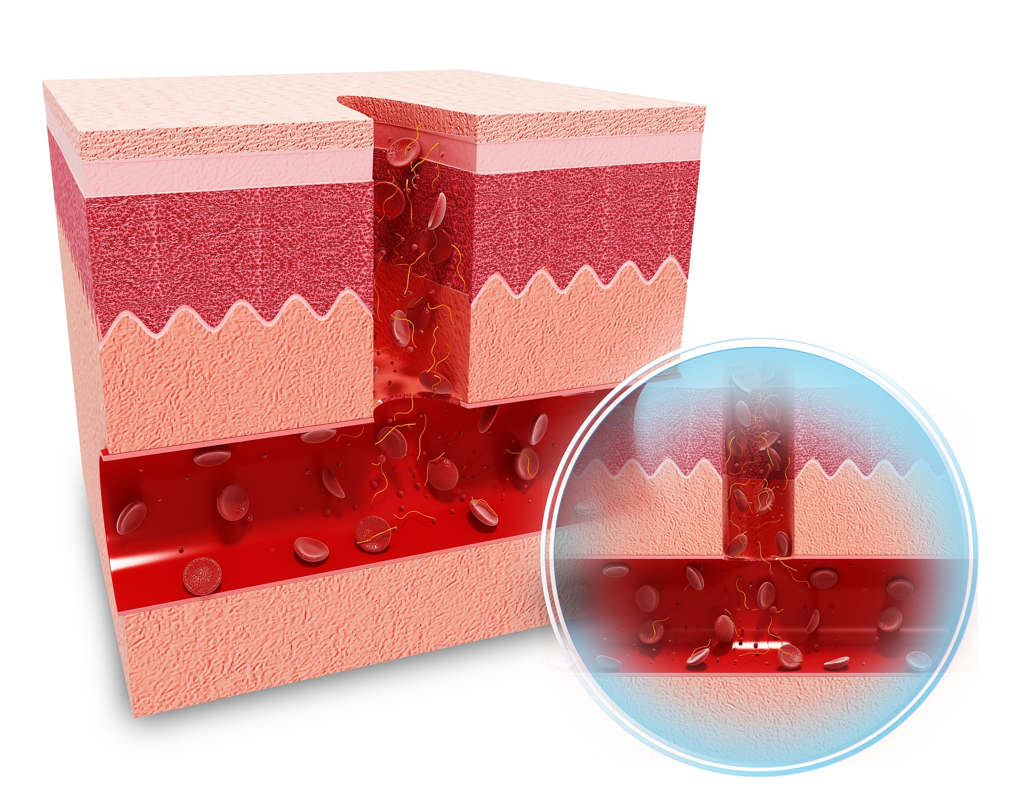 炎症细胞与斑块破裂：新生血管形成的双重作用