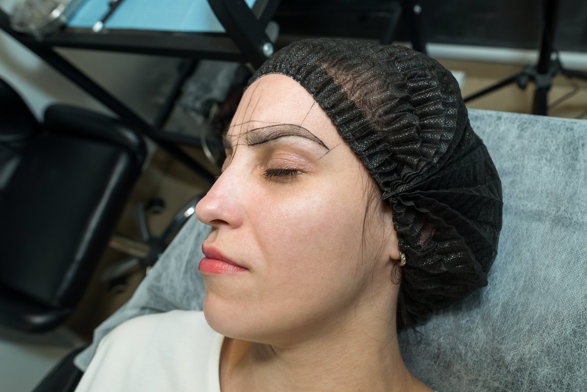 纹眉除色的激光方法