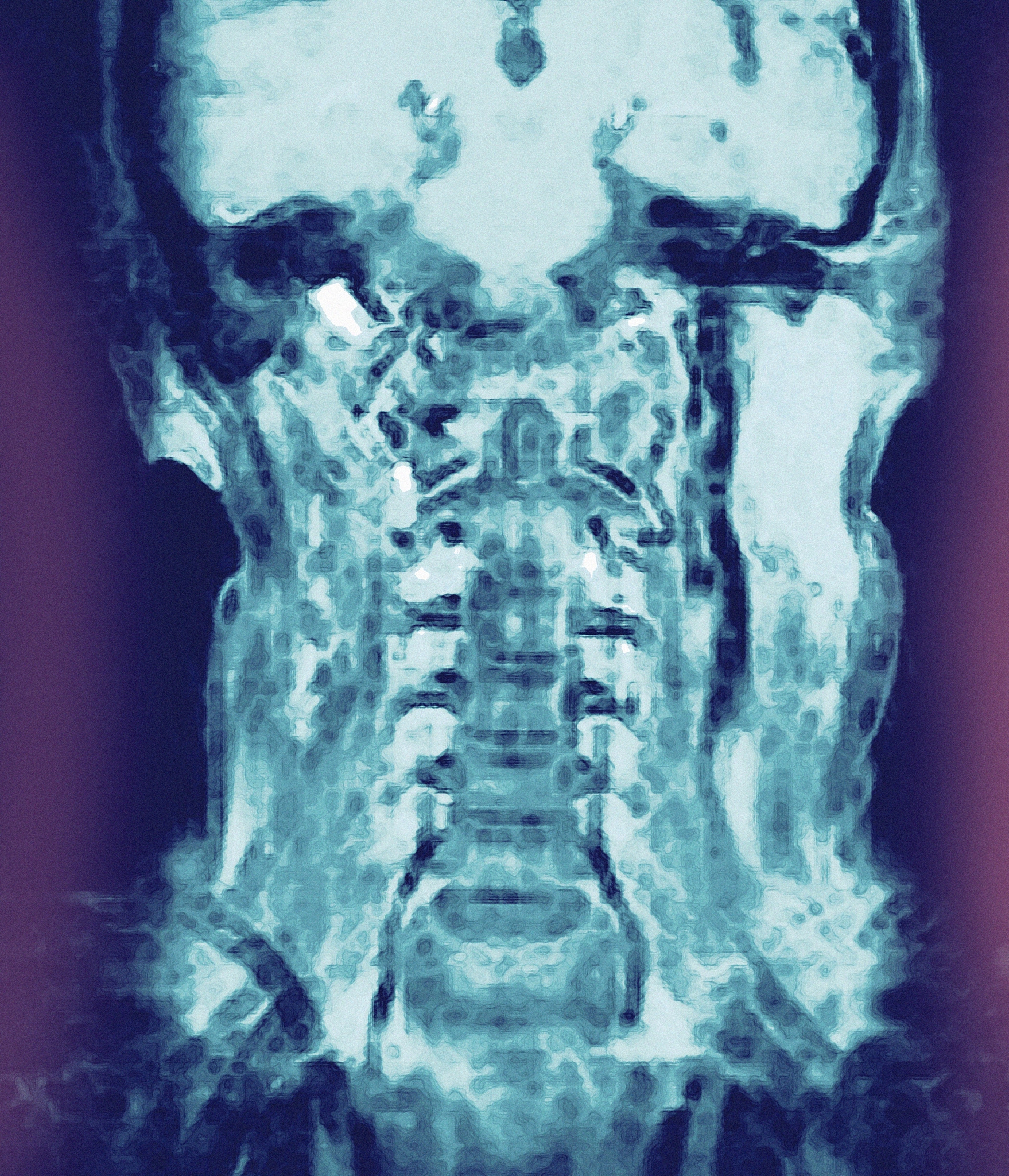 CT 扫描：灰度值与密度关系 - 高灰度值代表高密度