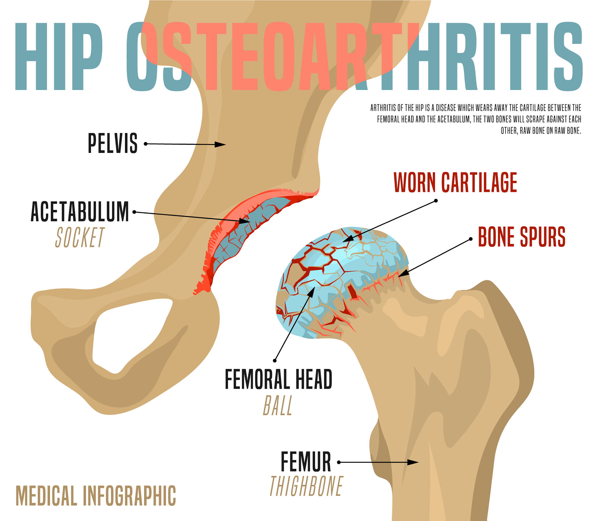 高龄股骨粗隆间骨折术后饮食指南：促进康复的关键！