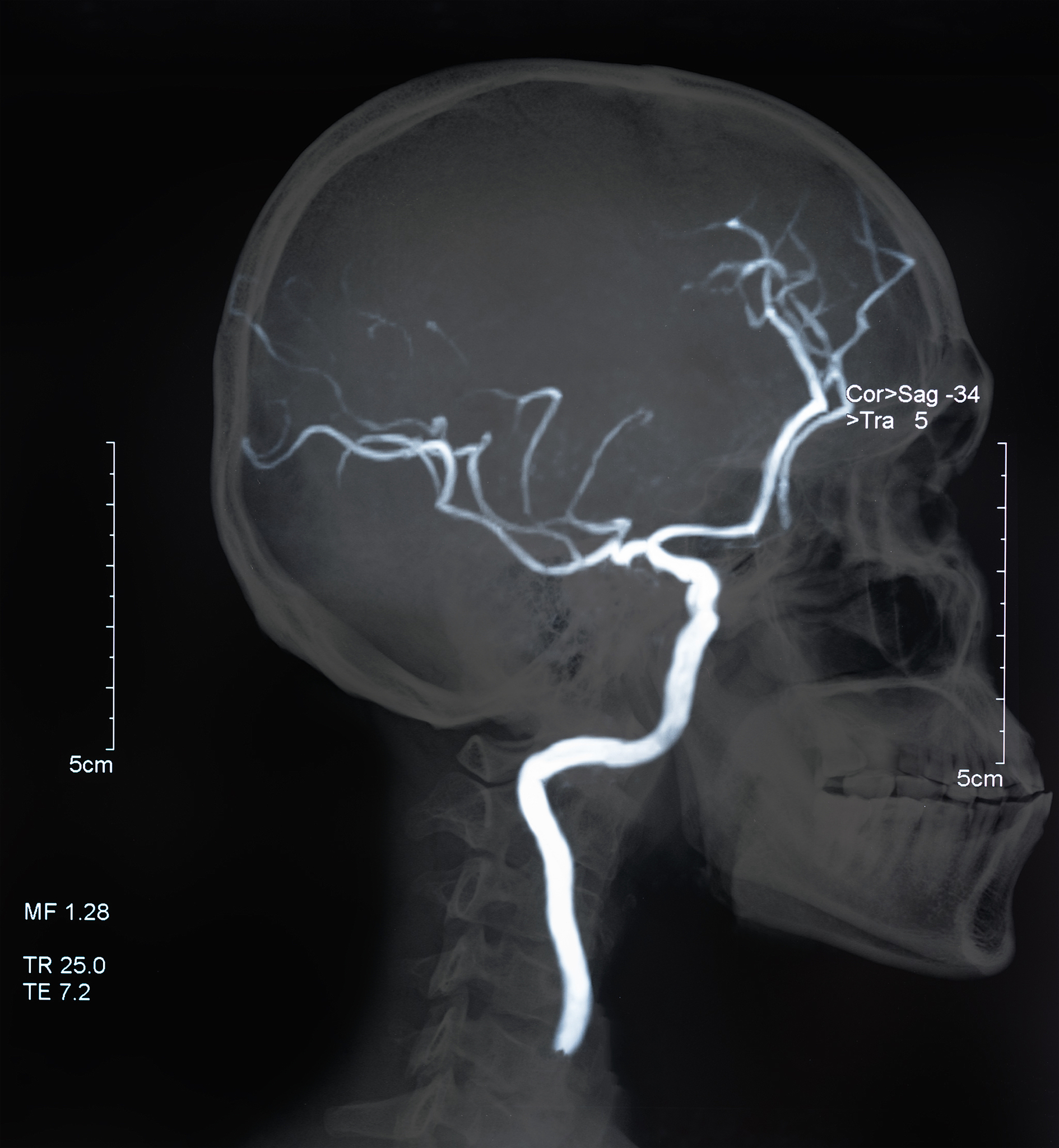 颈动脉甜甜圈征：CTA图像上的填充缺损