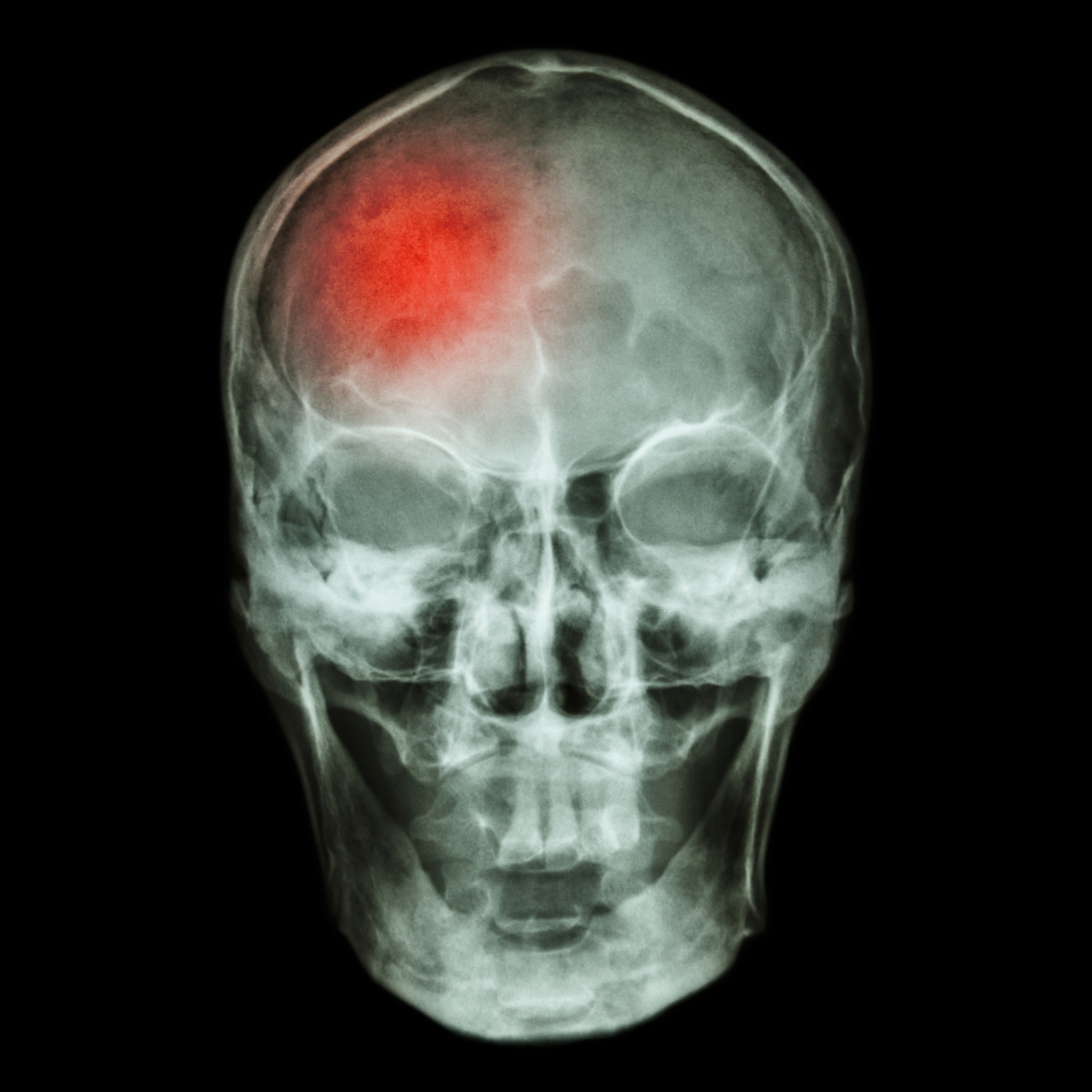 Ultrasound Imaging Prevents Severe Cerebrovascular Events by Enabling Early Detection and Treatment of Floating Thrombus in the Carotid Artery