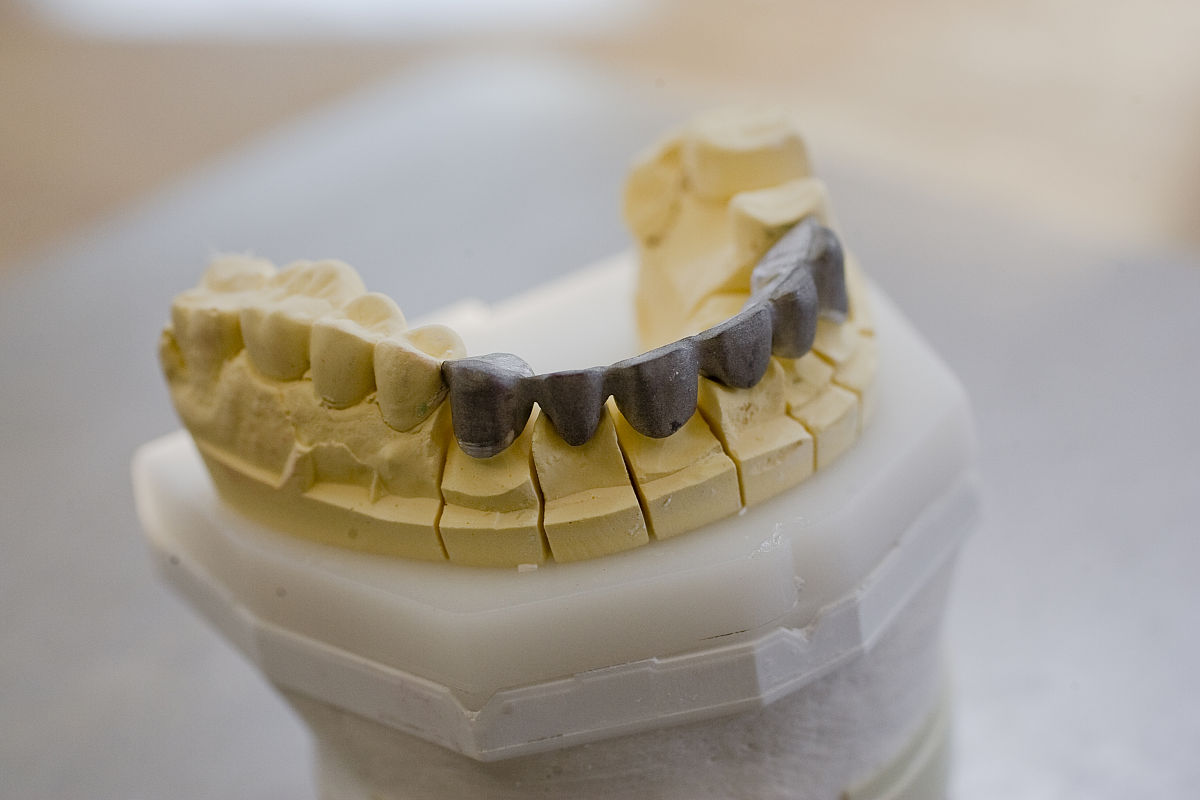 后牙缺失有牙周炎选择士卓曼的软组织水平种植体还是骨水平种植体？