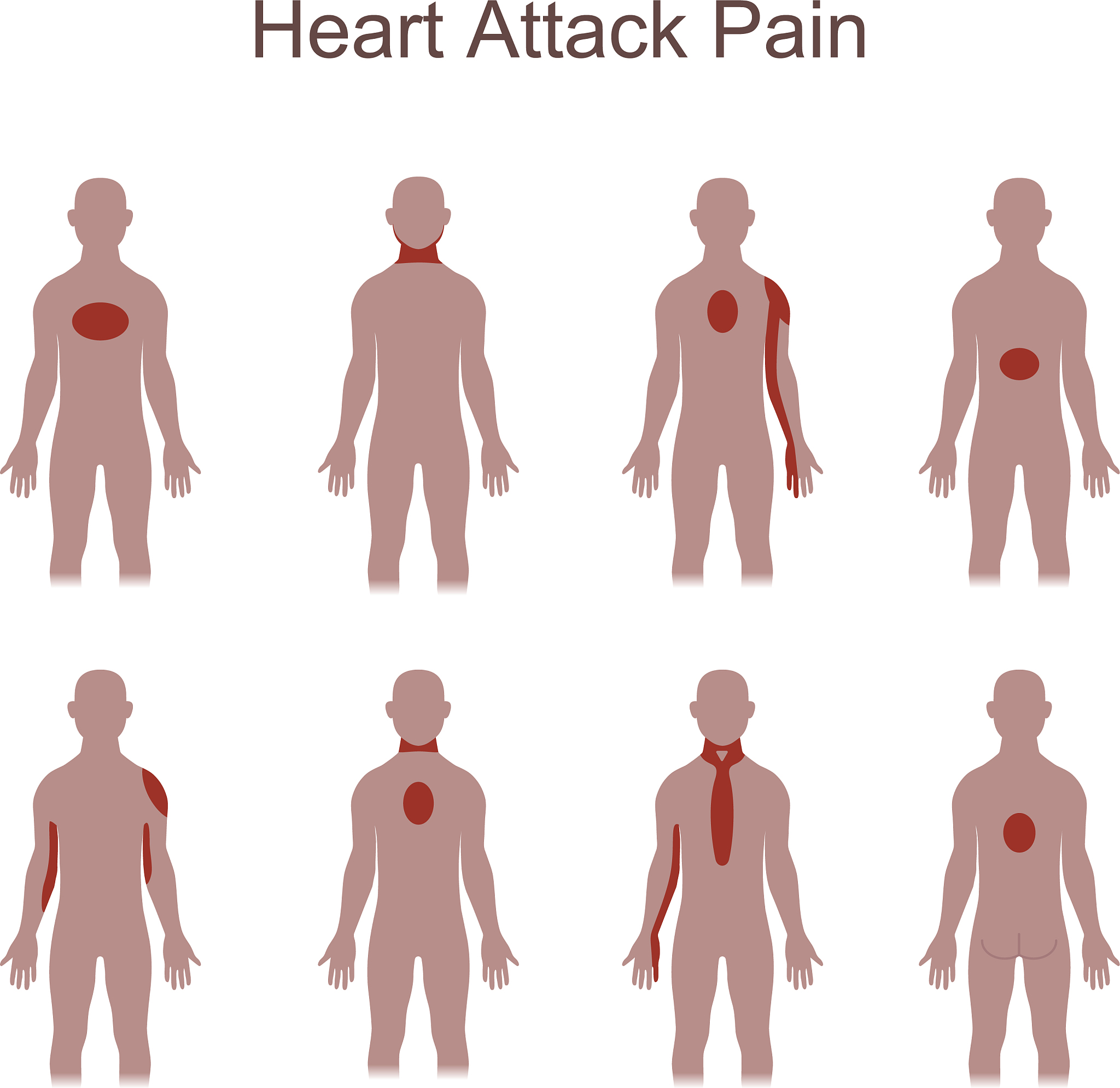 急性ST段抬高型心肌梗死伴高血压3级：症状、治疗和预防