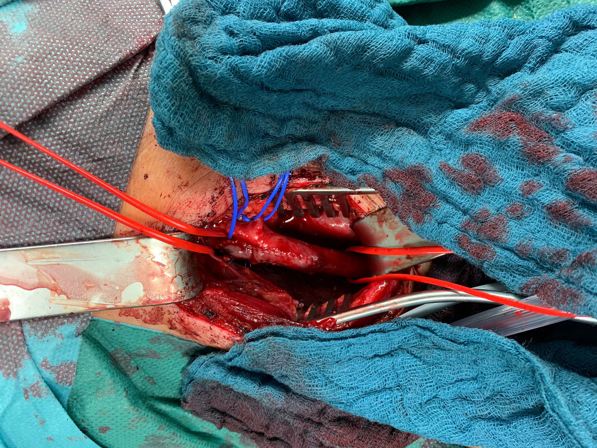 in carotid surgery, the ateria carotis is exposed and wrapped in