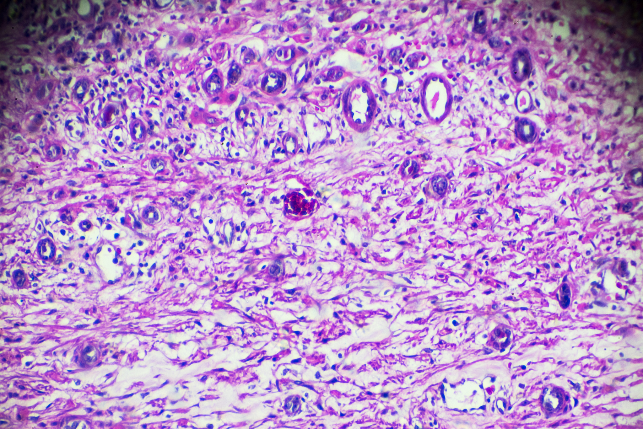膜性肾病研究趋势：免疫机制、生物标志物、治疗策略