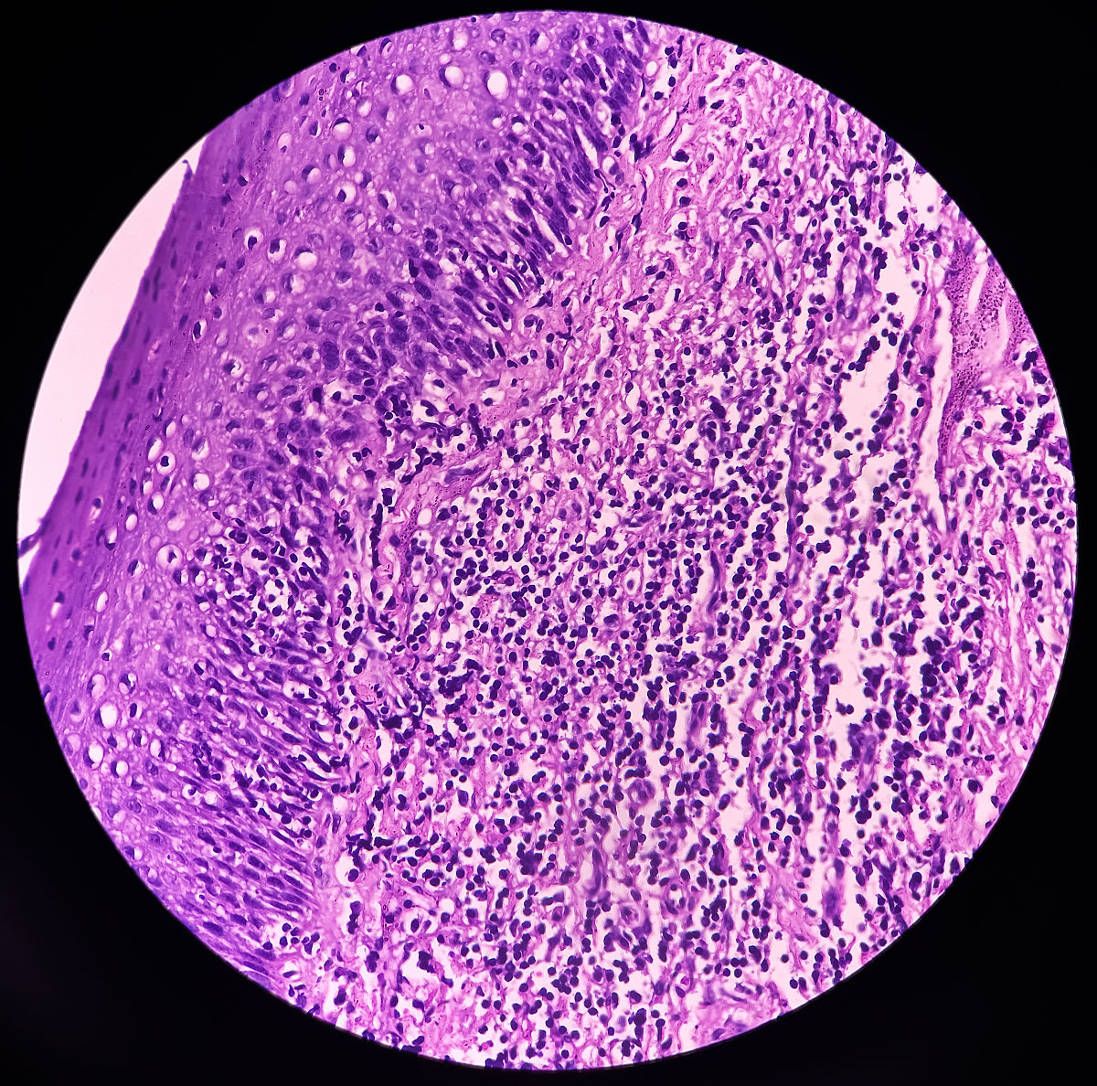 急性扁桃体炎：发热、咳嗽、咳痰、疼痛的原因