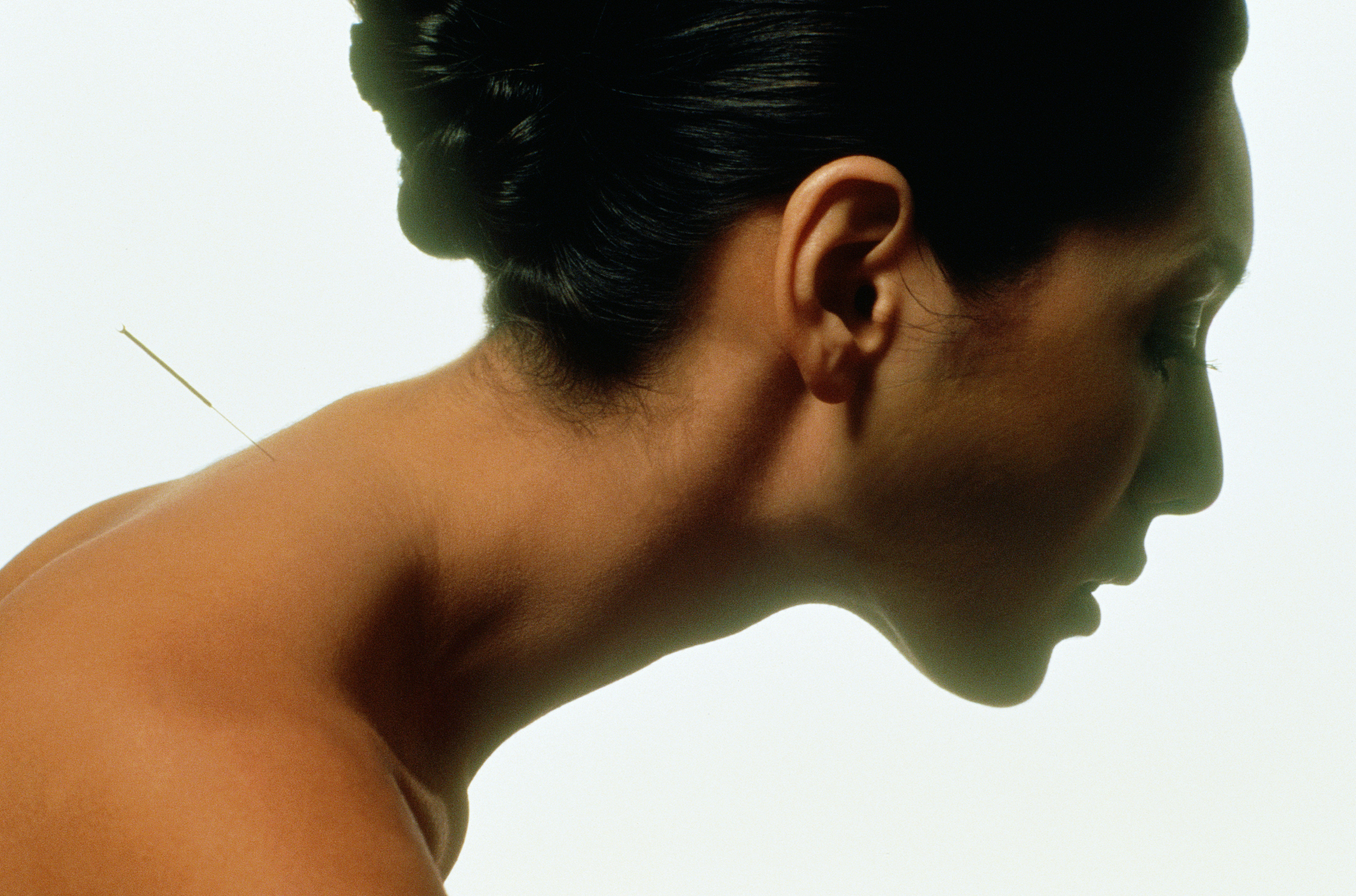 acupuncture of japanese woman