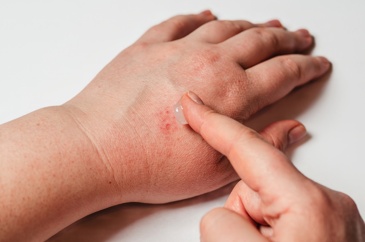 我今年20岁女每次被蚊子都会起一个很大很硬的包别人则不会。是什么原因用肥皂加盐可以吗