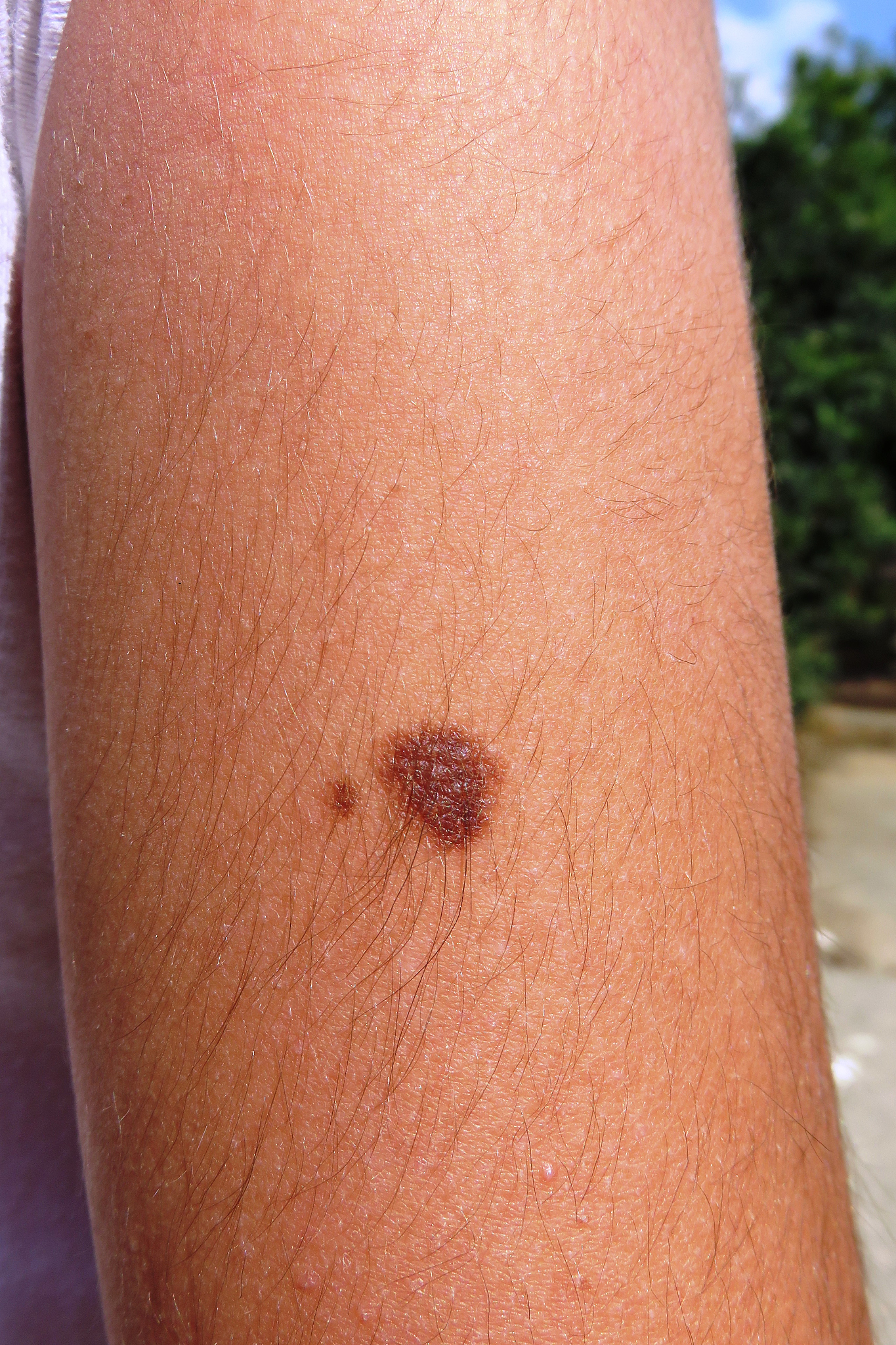 mole on the skin