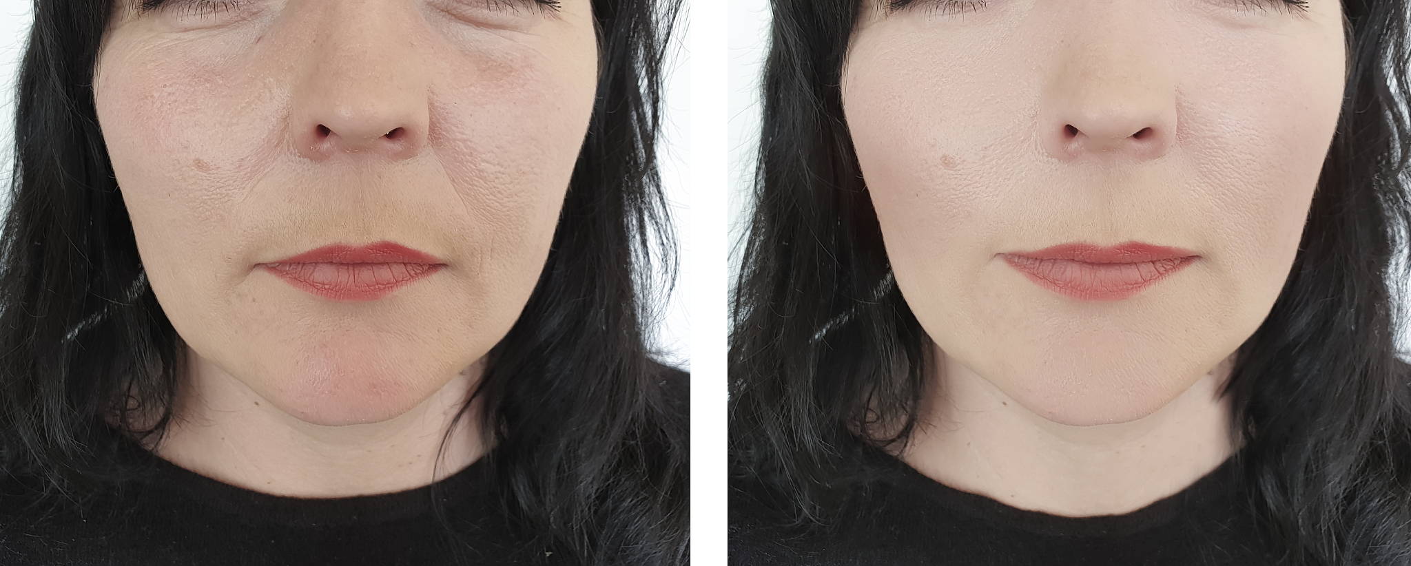 玻尿酸填充：全面解析医美知识，安全有效