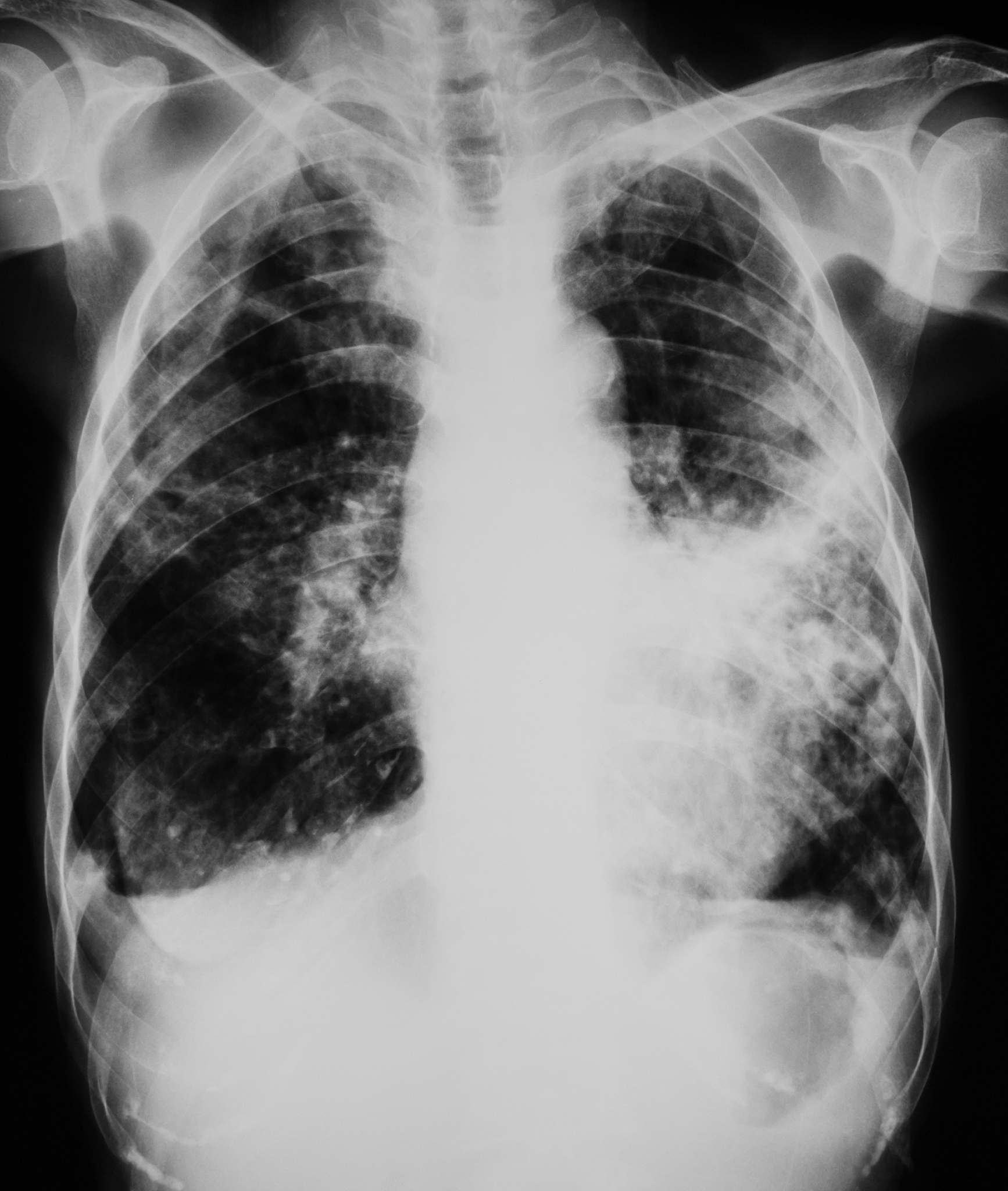 患者X线胸片示右肺上叶后段薄壁空洞直径4cm内有较小的液面空洞周围肺内有渗出病变右下叶及左肺中下野有多发斑片状渗出。最可能的诊断为