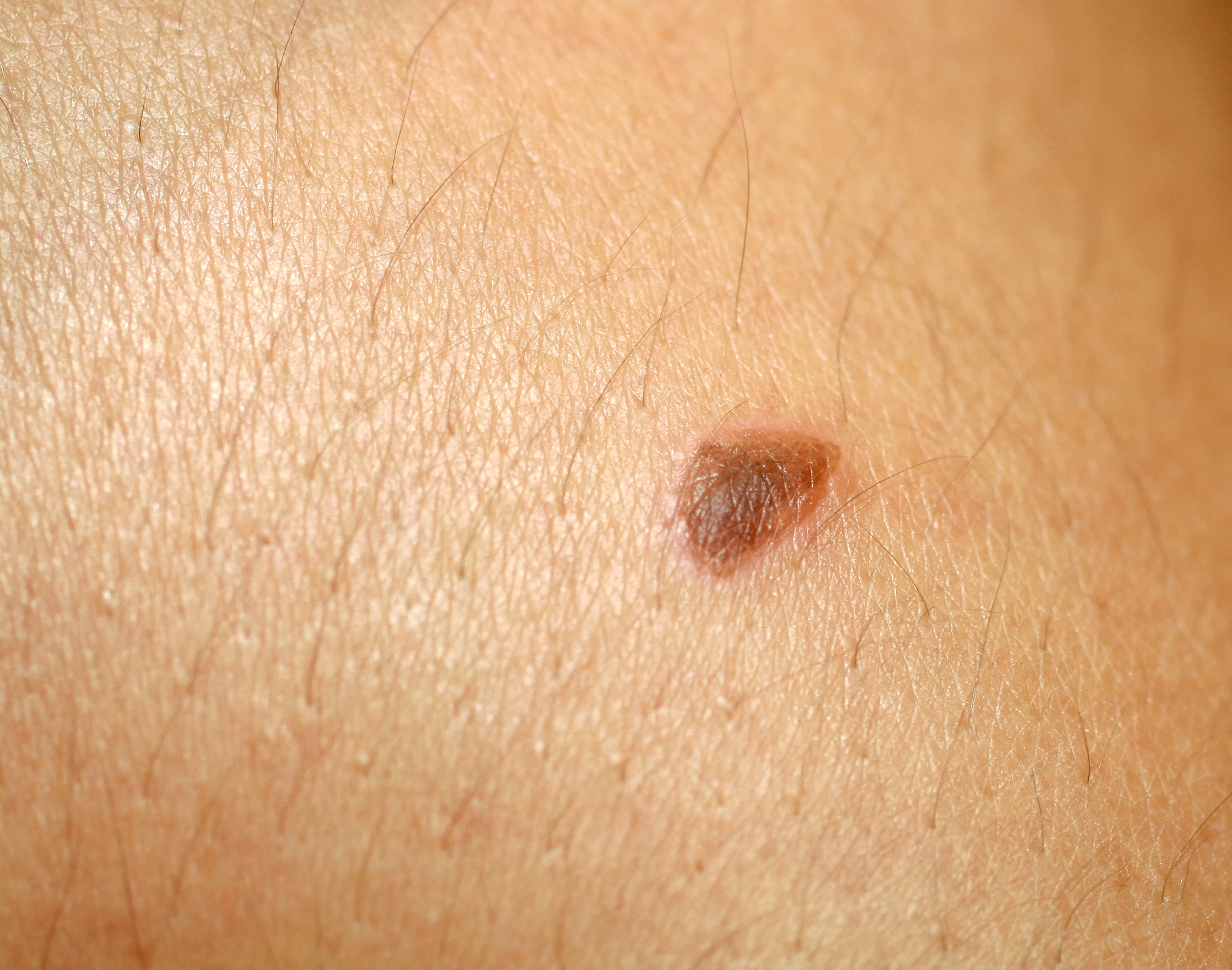 burn on the skin. blister on the skin