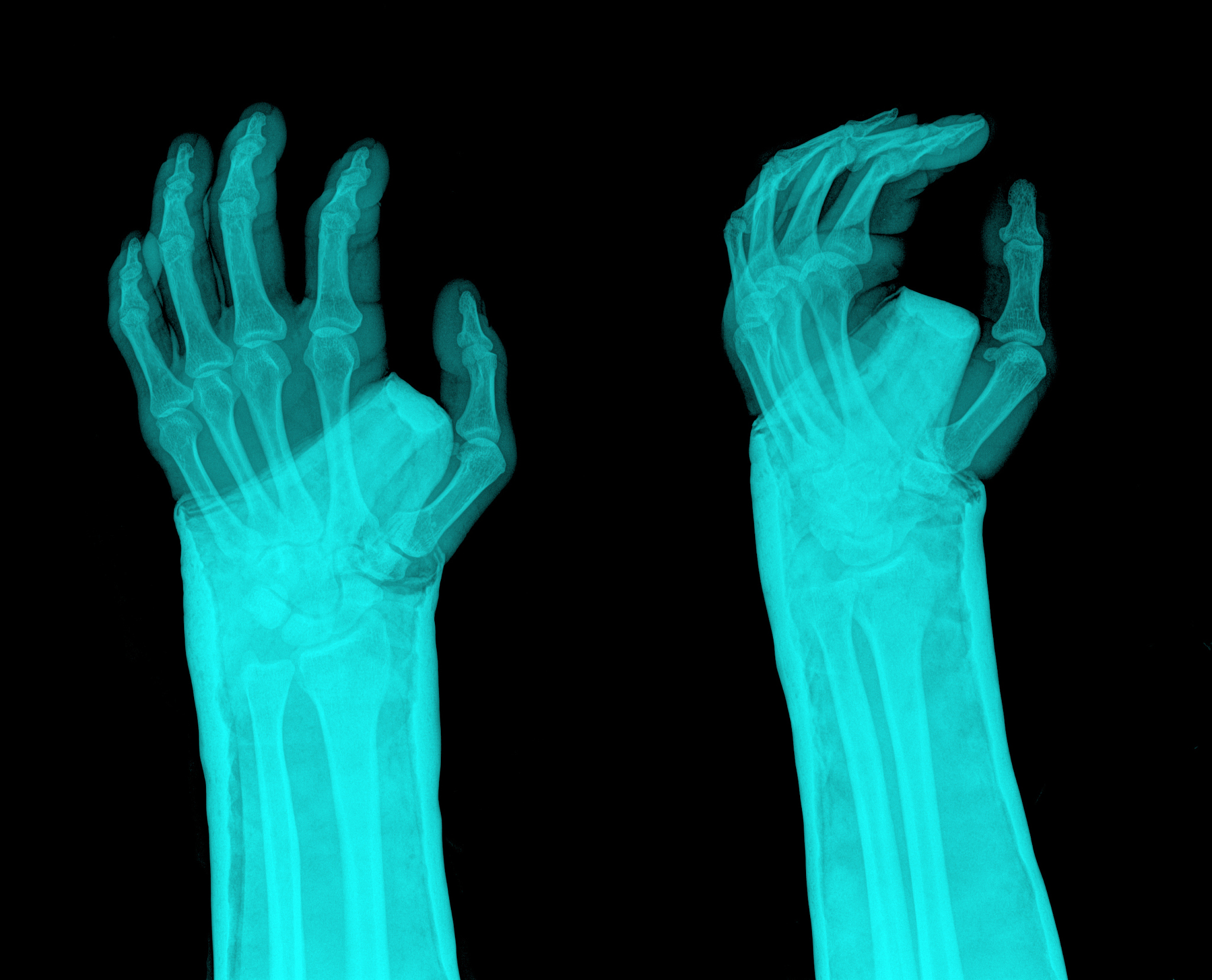 折腕控制的危害：关节结构的破坏