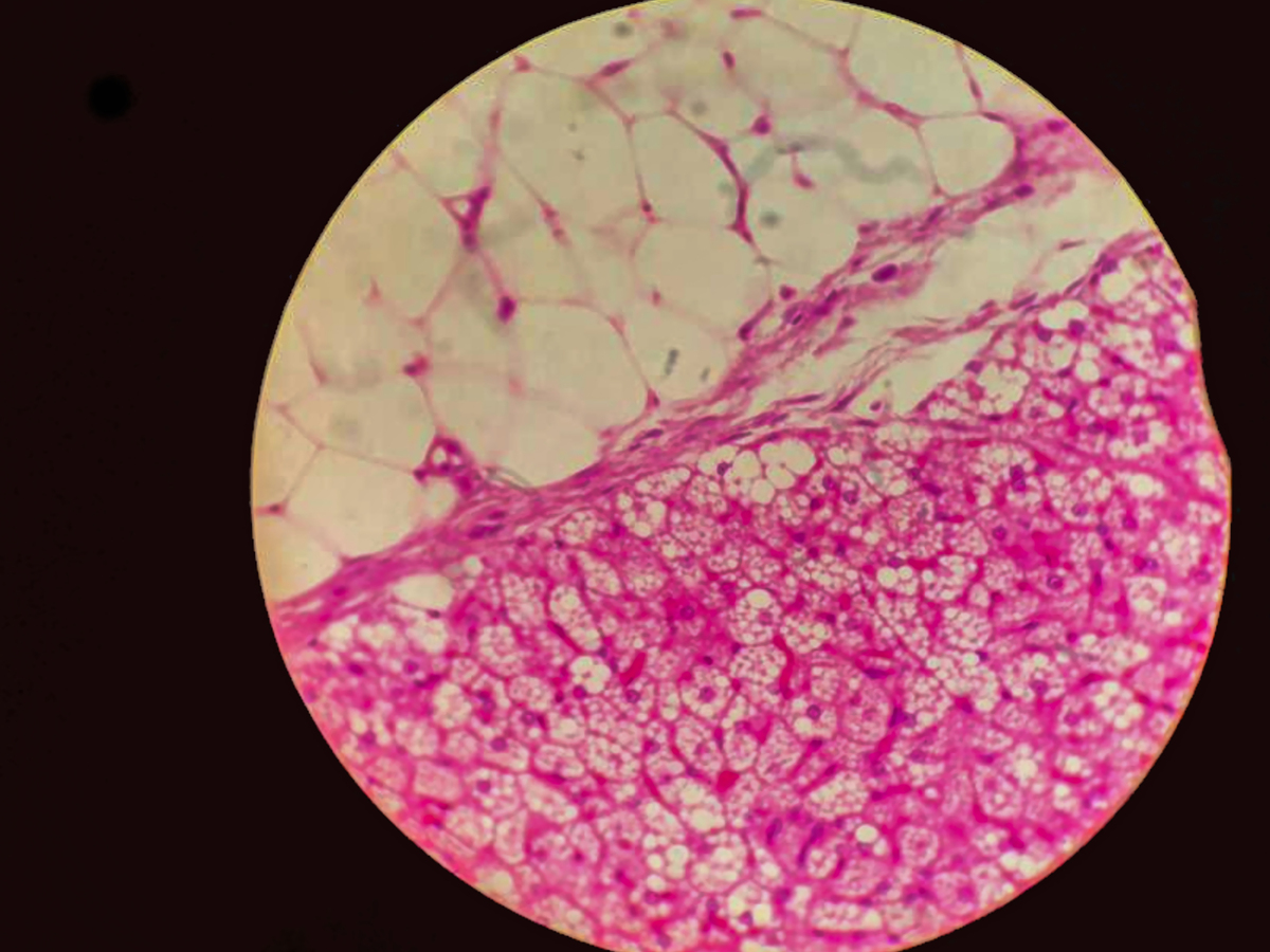肝星状细胞转化为成熟纤维母细胞机制：肝纤维化关键过程