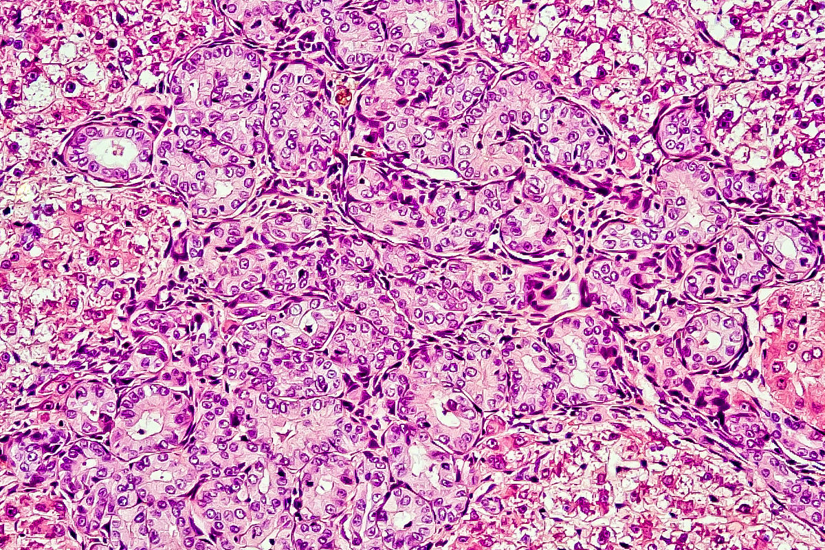 在HBV相关肝癌的分子机制中HBV基因组中的PreS1区域的突变是一个重要的因素。这种突变可能会导致HBV感染的增加和肝细胞的损伤从而促进肝癌的发展。此外HBV X蛋白也被认为是肝癌发生的重要因素之一。