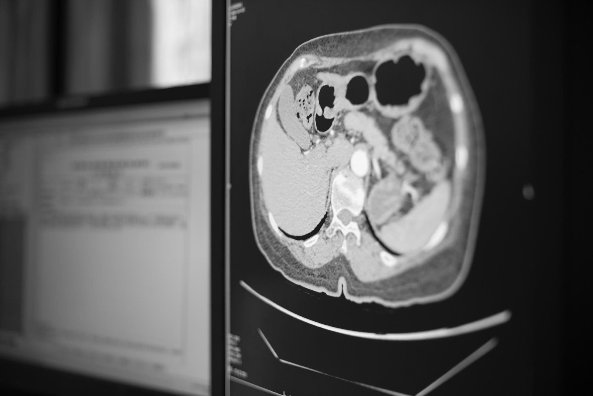 闭合性胸腹部损伤合并创伤性脾破裂腹腔镜探查备剖腹探查术术前准备