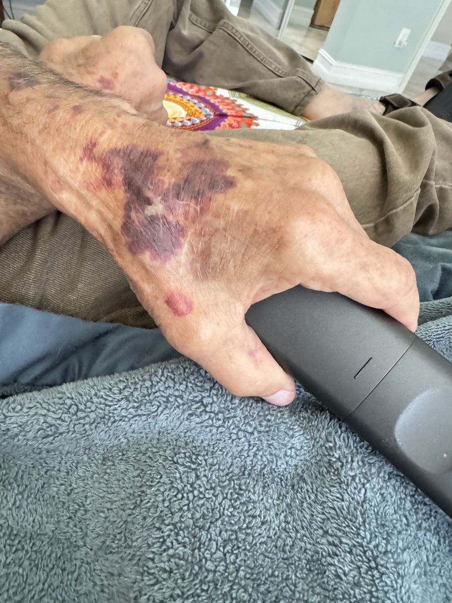 静脉曲张不手术的后果：轻则皮疹，重则危及生命！