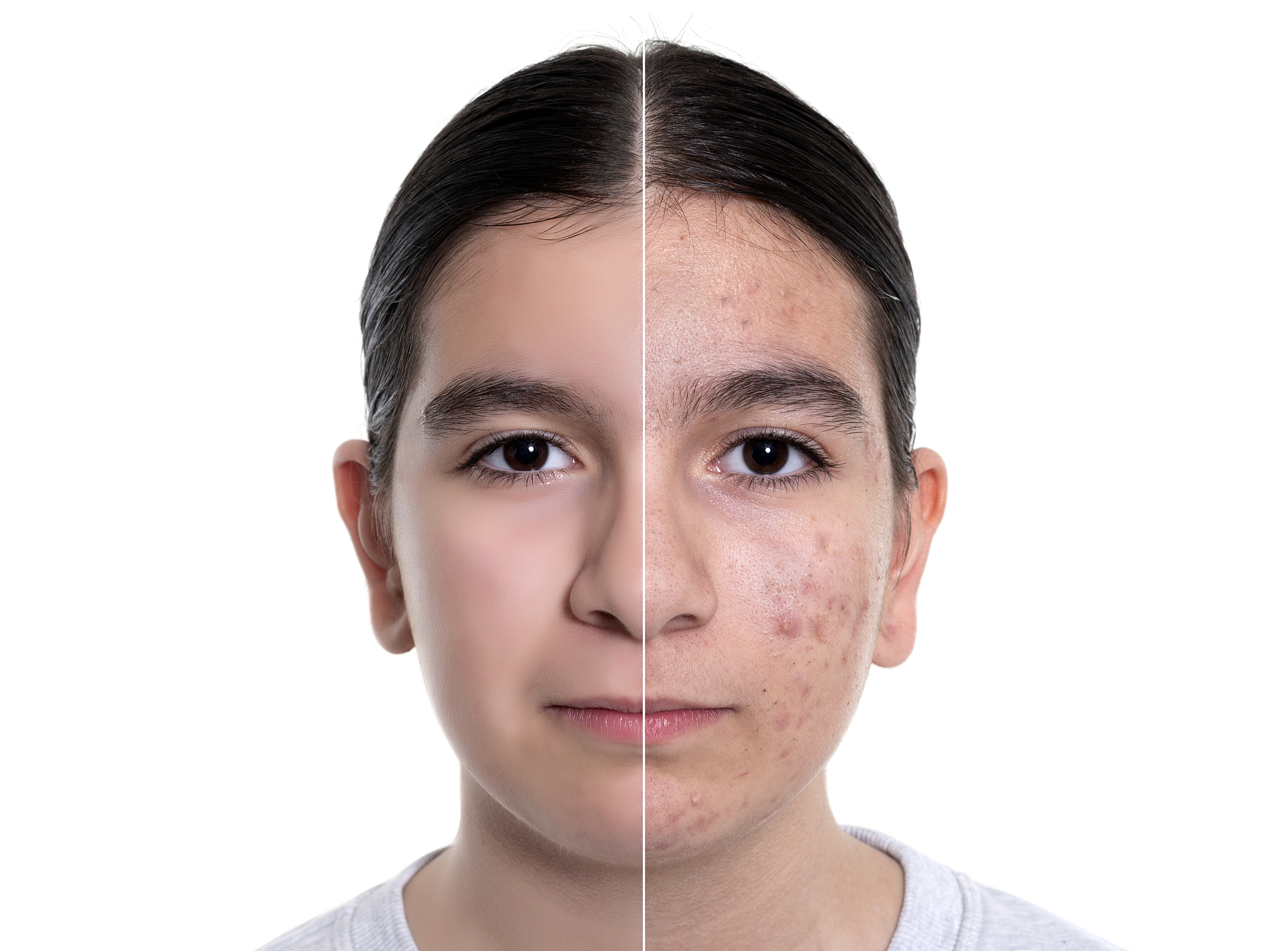 teenage girl skin problems during adolescence