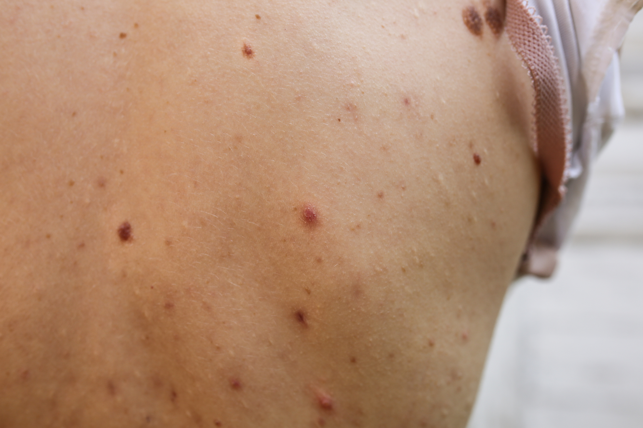 many birthmarks on the girl's back. medical health photo. woman'