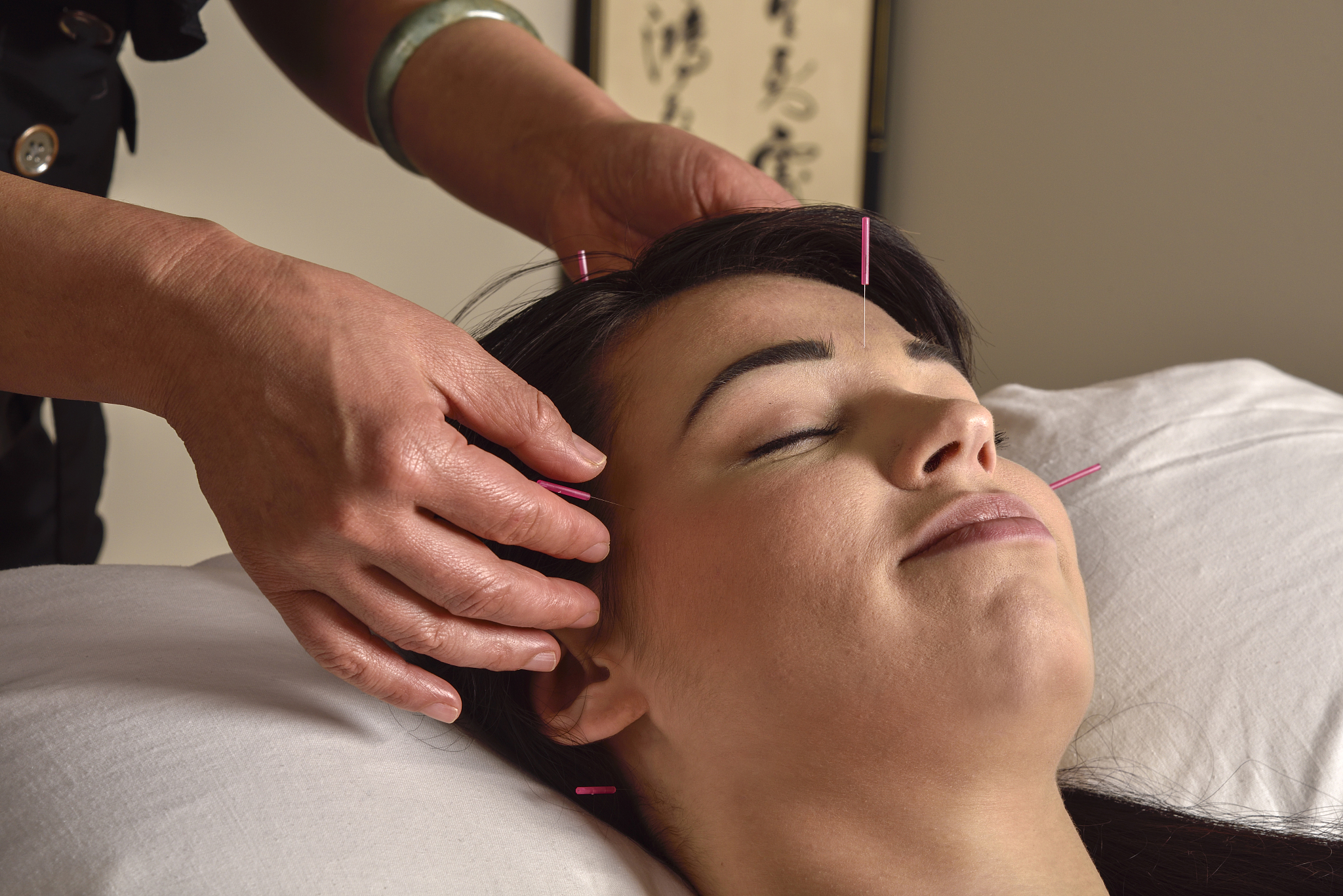 acupuncture treatment on head and temples