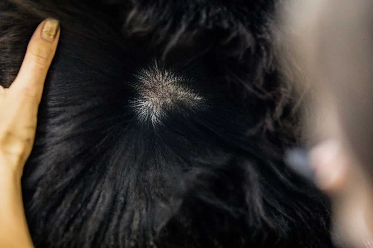 脂溢性皮炎治疗方法：症状、护理和药物