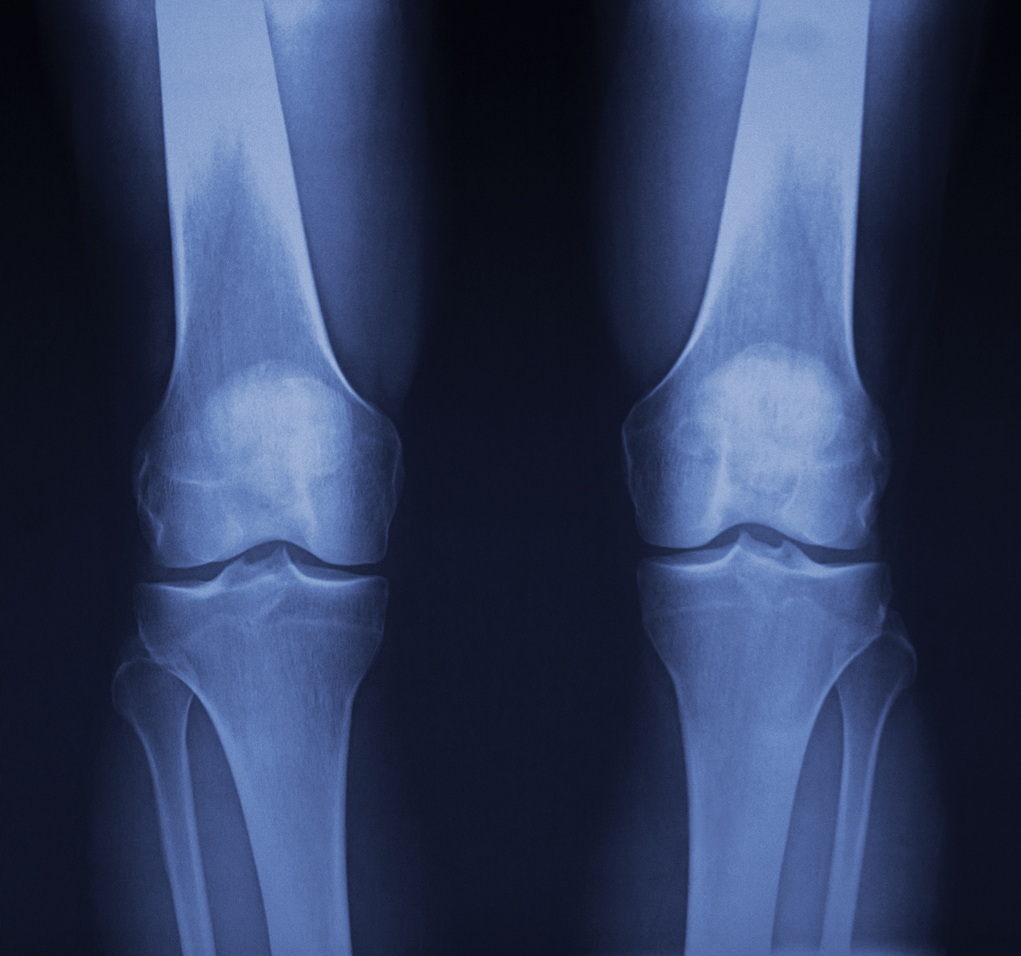 高龄股骨粗隆间骨折的原因及预防：全面解析