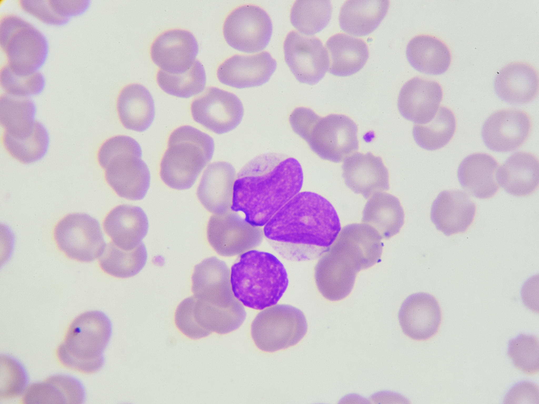 单核细胞比例升高：原因、症状和治疗